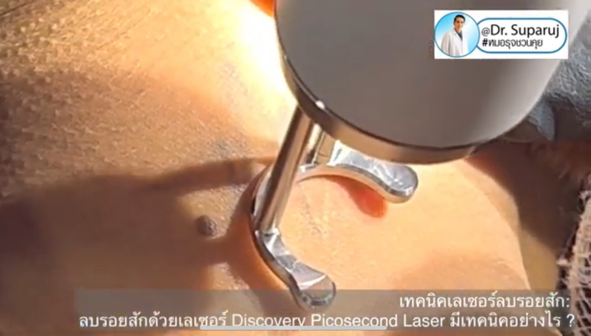 ทำไมต้องลบรอยสักด้วย พิโค่เลเซอร์ Picosecond Laser