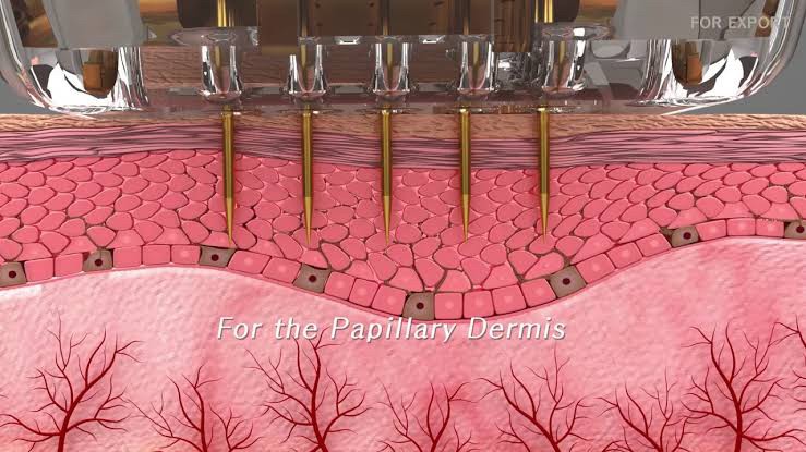 Update Concept ใหม่ในการรักษาฝ้า ด้วยการฟื้นฟูผิวด้วยการใช้ เข็มพลังงานคลื่นวิทยุ + Exosomes (SylfirmX Plus Fractional RF MicroNeedle + Exosomes for Melasma Skin Rehabilitation) Update Concept ใหม่ในการรักษาฝ้า ด้วยการฟื้นฟูผิวด้วยการใช้ เข็มพลังงานคลื่นวิทยุ + Exosomes (SylfirmX Plus Fractional RF MicroNeedle + Exosomes for Melasma Skin Rehabilitation)