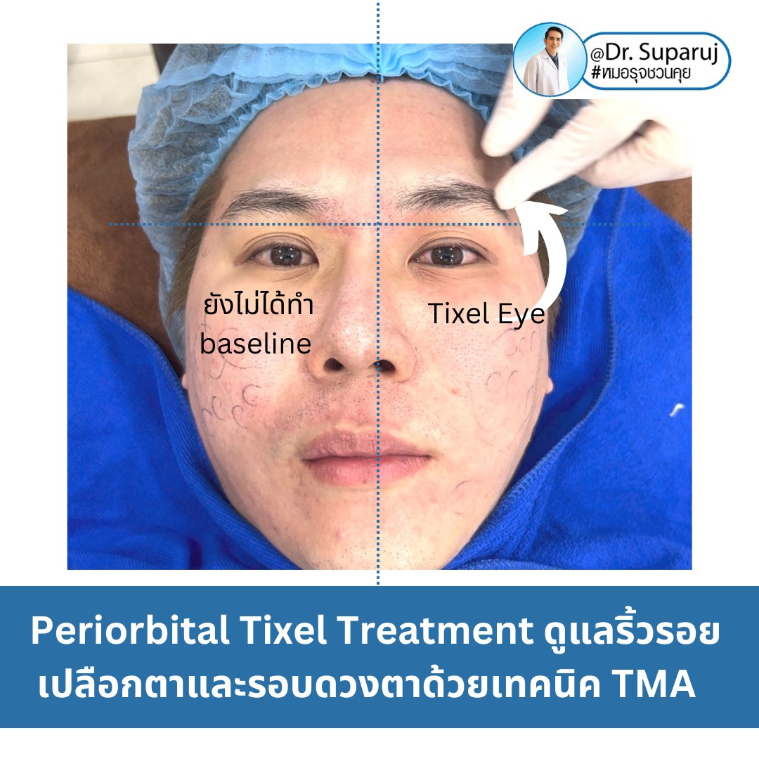 Update นวัตกรรมใหม่ล่าสุด Tixel ทิ๊กเซลล์ รักษาหลุมสิว ริ้วรอย แผลเป็น + Periorbital Tixel Treatment ดูแลริ้วรอยเปลือกตาและรอบดวงตาด้วยเทคนิค TMA = Thermo-mechanical Abaltion