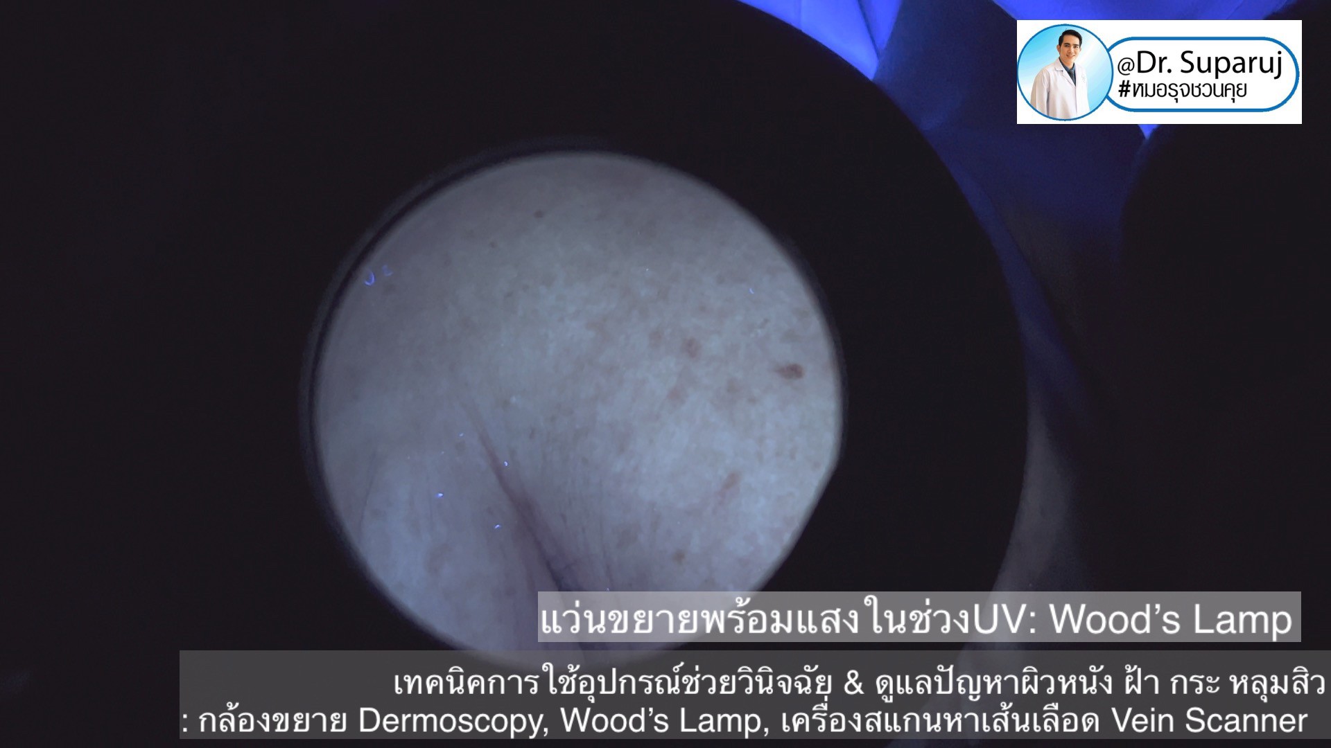 เทคนิคการใช้อุปกรณ์ช่วยวินิจฉัย & ดูแลปัญหาผิวหนัง ฝ้า กระ หลุมสิว: กล้องขยาย Dermoscopy, แว่นขยายพร้อมแสงในช่วงUV: Wood’s Lamp, เครื่องสแกนหาเส้นเลือด Vein Scanner เทคนิคการใช้อุปกรณ์ช่วยวินิจฉัย & ดูแลปัญหาผิวหนัง ฝ้า กระ หลุมสิว: กล้องขยาย Dermoscopy, แว่นขยายพร้อมแสงในช่วงUV: Wood’s Lamp, เครื่องสแกนหาเส้นเลือด Vein Scanner