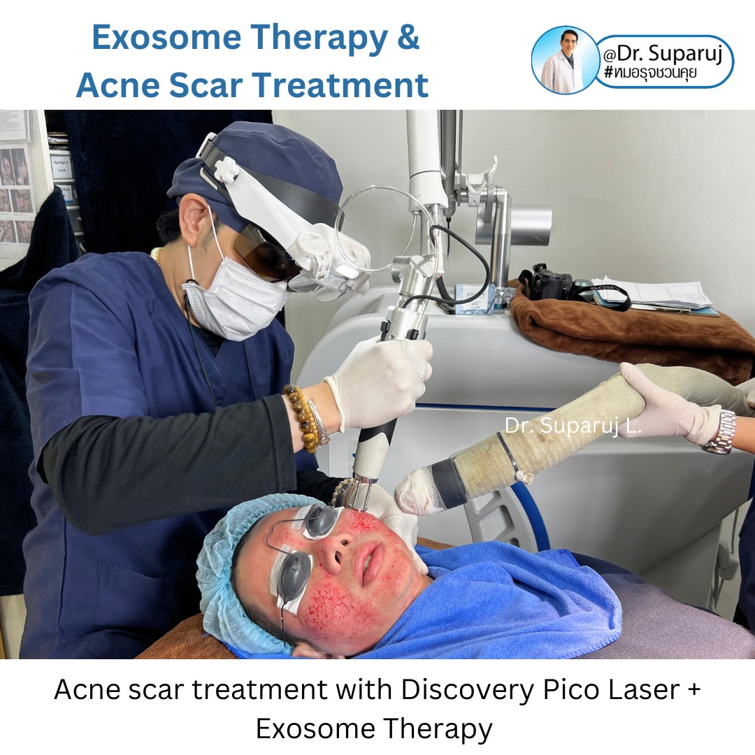 เป็นหลุมสิว แต่ยังไม่พร้อมรักษาหลุมสิว ทำอย่างไรดี? (+ เทคนิคการ เลือกใช้วิธีรักษาลุมสิวเบื้องต้นครับ) เป็นหลุมสิว แต่ยังไม่พร้อมรักษาหลุมสิว ทำอย่างไรดี? (+ เทคนิคการ เลือกใช้วิธีรักษาลุมสิวเบื้องต้นครับ)