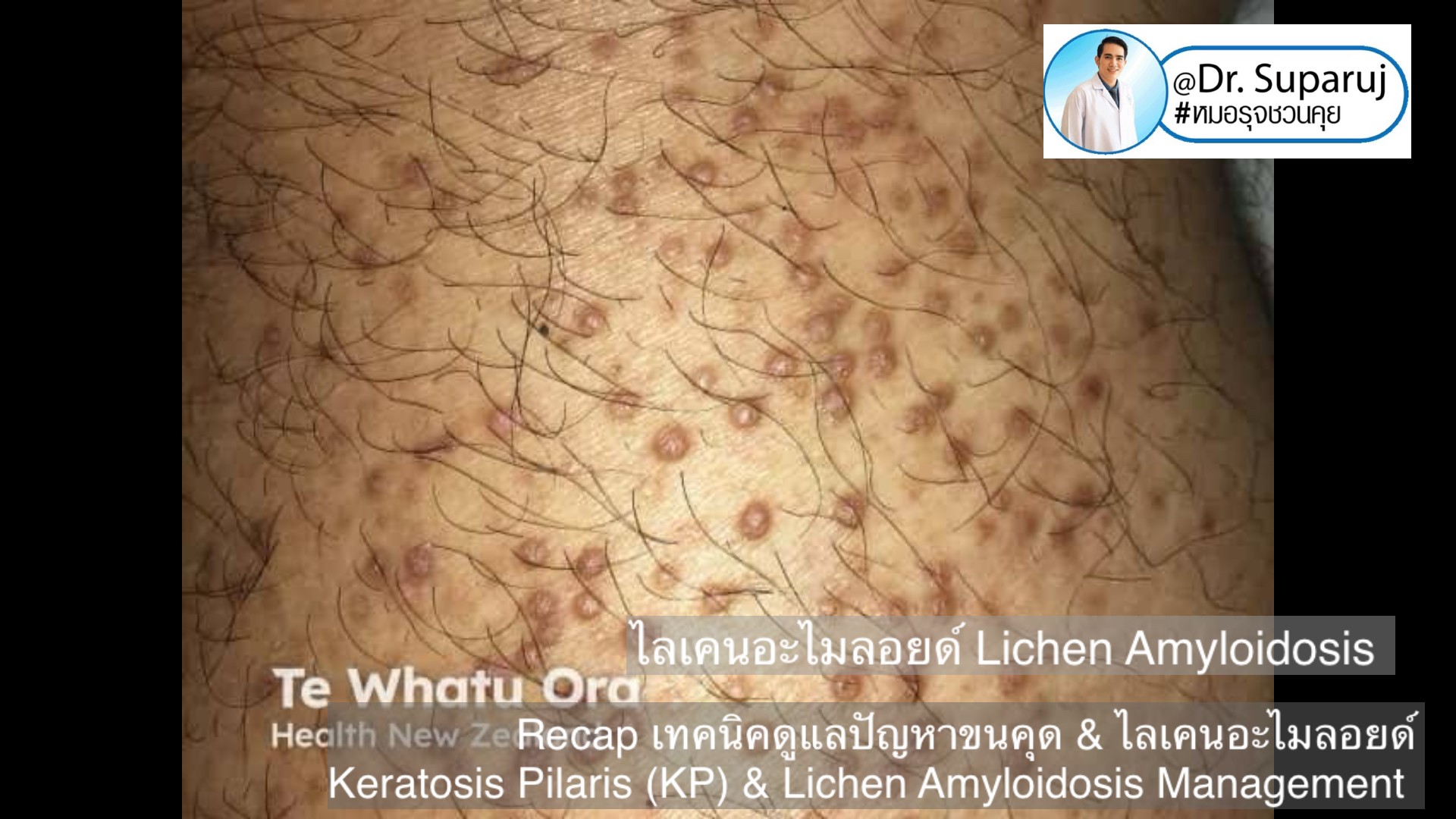 Recap เทคนิคดูแลปัญหาขนคุด & ไลเคนอะไมลอยด์ Keratosis Pilaris (KP) & Lichen Amyloidosis Management