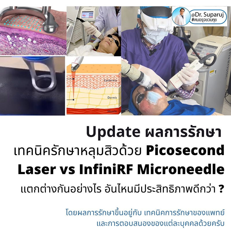 แนะนำเทคนิครักษาหลุมสิว: ดูแลหลุมสิวด้วยเข็มพลังงานคลื่นวิทยุ Infini RF Microneedle