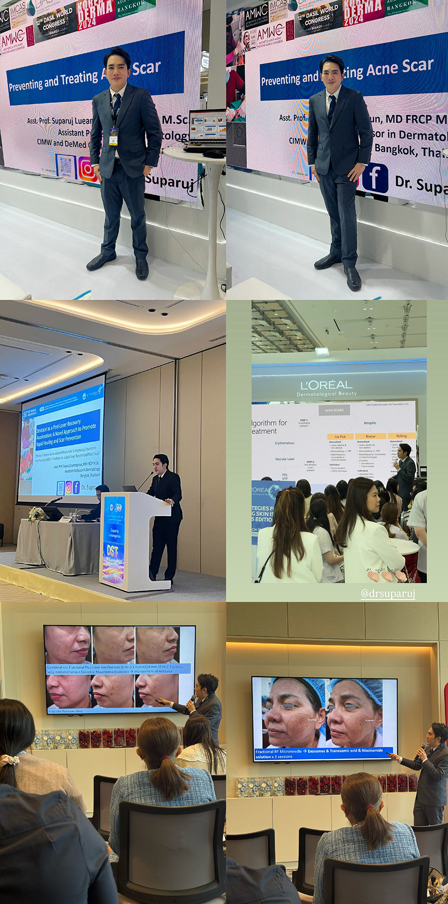 ผศ. นพ. ศุภะรุจ เลื่องอรุณ (หมอรุจ) ว 31954 ได้รับ เกียรติเป็นวิทยากร บรรยายในงานประชุมใหญ่สามัญประจำปีของสมาคมแพทย์ผิวหนังแห่งประเทศไทย(DST Annual Meeting 2025) ผศ. นพ. ศุภะรุจ เลื่องอรุณ (หมอรุจ) ว 31954 ได้รับ เกียรติเป็นวิทยากร บรรยายในงานประชุมใหญ่สามัญประจำปีของสมาคมแพทย์ผิวหนังแห่งประเทศไทย(DST Annual Meeting 2025)