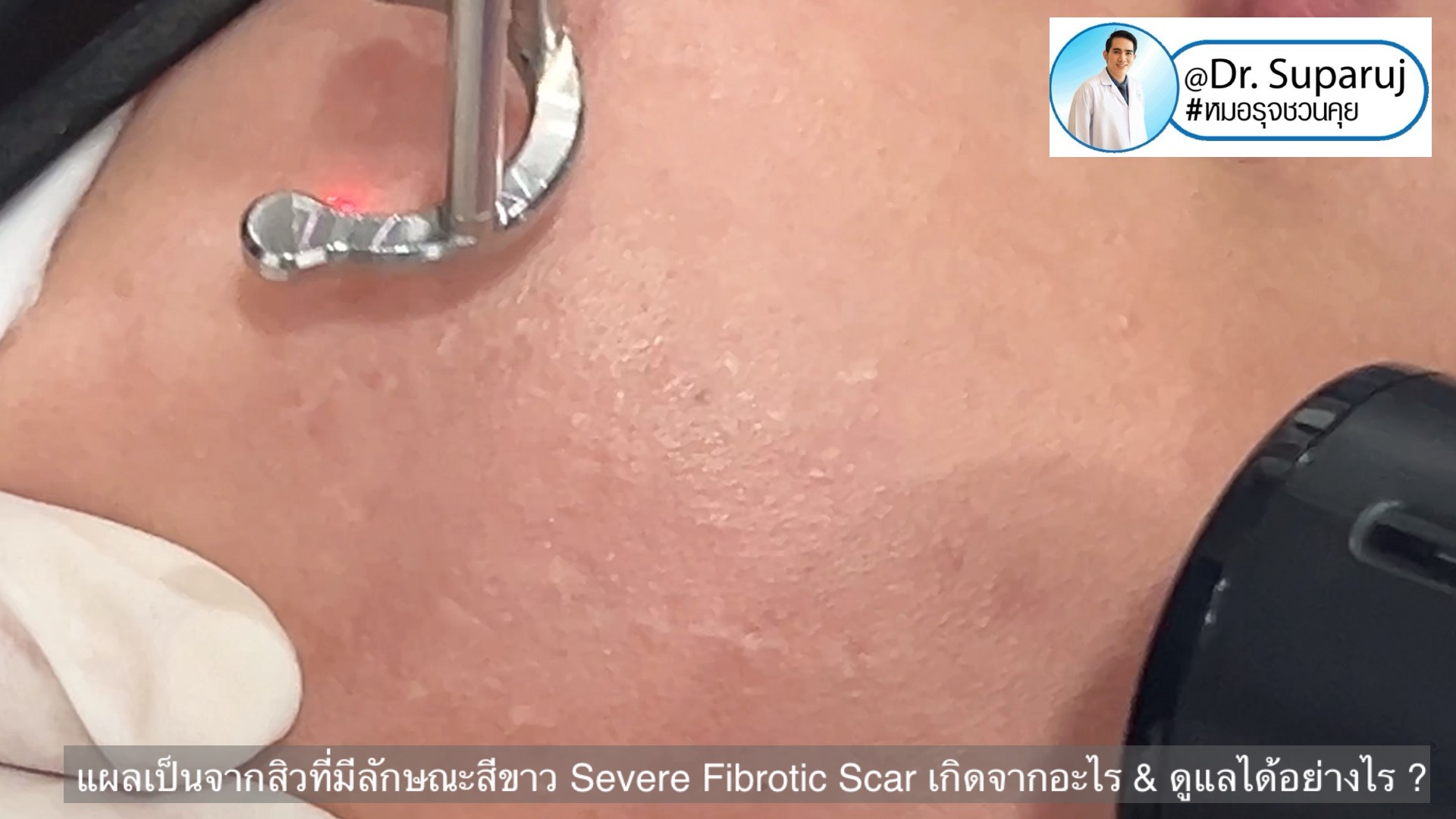 แผลเป็นจากสิวที่มีลักษณะสีขาว severe fibrotic acne scar เกิดจากอะไร & ดูแลได้อย่างไร ?