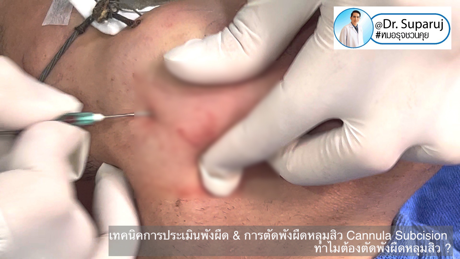 เทคนิคการประเมินพังผืด และการตัดพังผืดหลุมสิว Cannula Subcision ทำไมต้องตัดพังผืดรักษาหลุมสิว ? (Acne Scar Fibrosis Evaluation & Cannula Subcision Treatment) เทคนิคการประเมินพังผืด และการตัดพังผืดหลุมสิว Cannula Subcision ทำไมต้องตัดพังผืดรักษาหลุมสิว ? (Acne Scar Fibrosis Evaluation & Cannula Subcision Treatment)