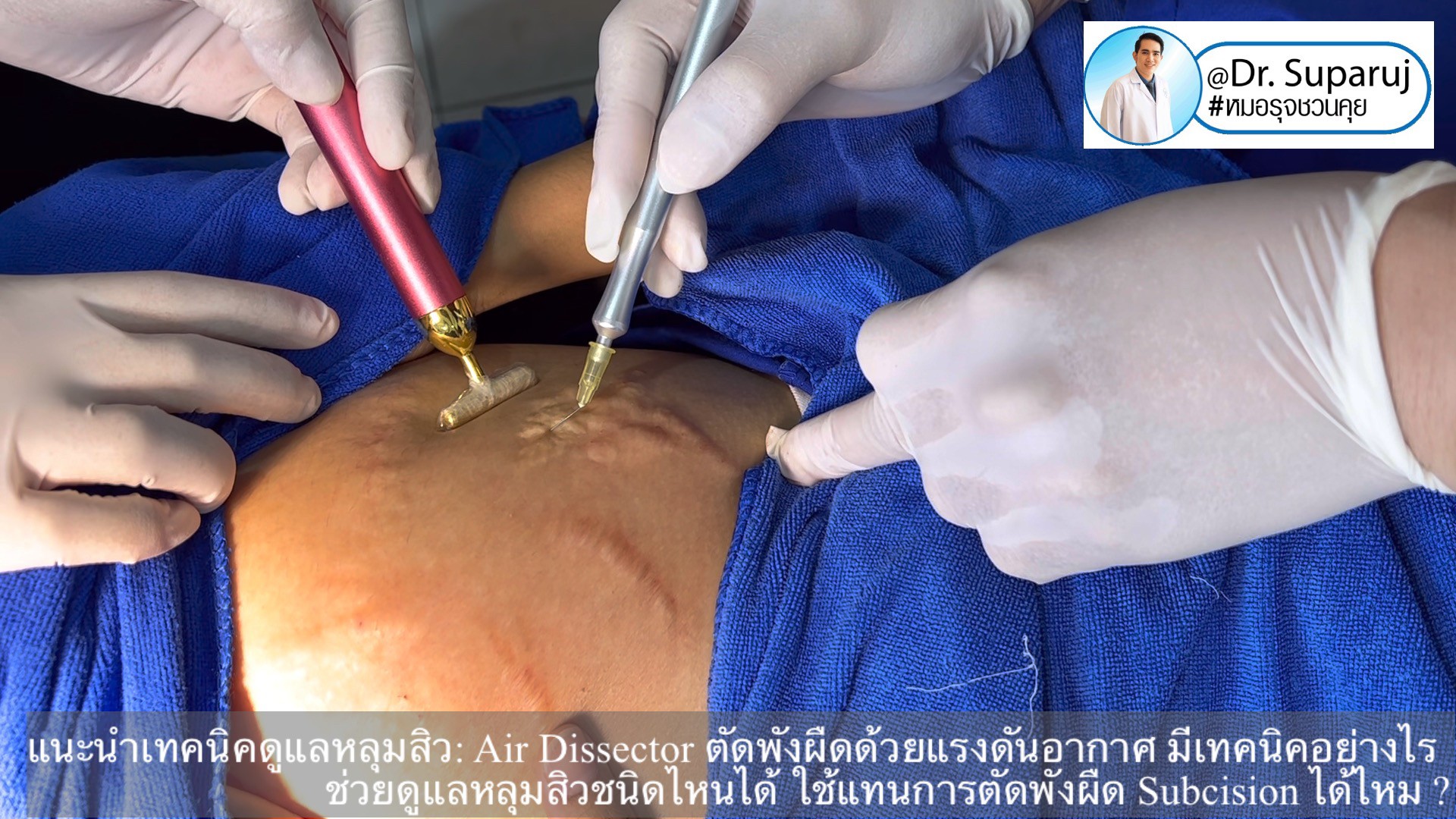 แนะนำเทคนิคดูแลหลุมสิว: Air Dissector ตัดพังผืดด้วยแรงดันอากาศ มีเทคนิคอย่างไร ช่วยดูแลหลุมสิวชนิดไหนได้ ใช้แทนการตัดพังผืด Subcision ได้ไหม ? แนะนำเทคนิคดูแลหลุมสิว: Air Dissector ตัดพังผืดด้วยแรงดันอากาศ มีเทคนิคอย่างไร ช่วยดูแลหลุมสิวชนิดไหนได้ ใช้แทนการตัดพังผืด Subcision ได้ไหม ?