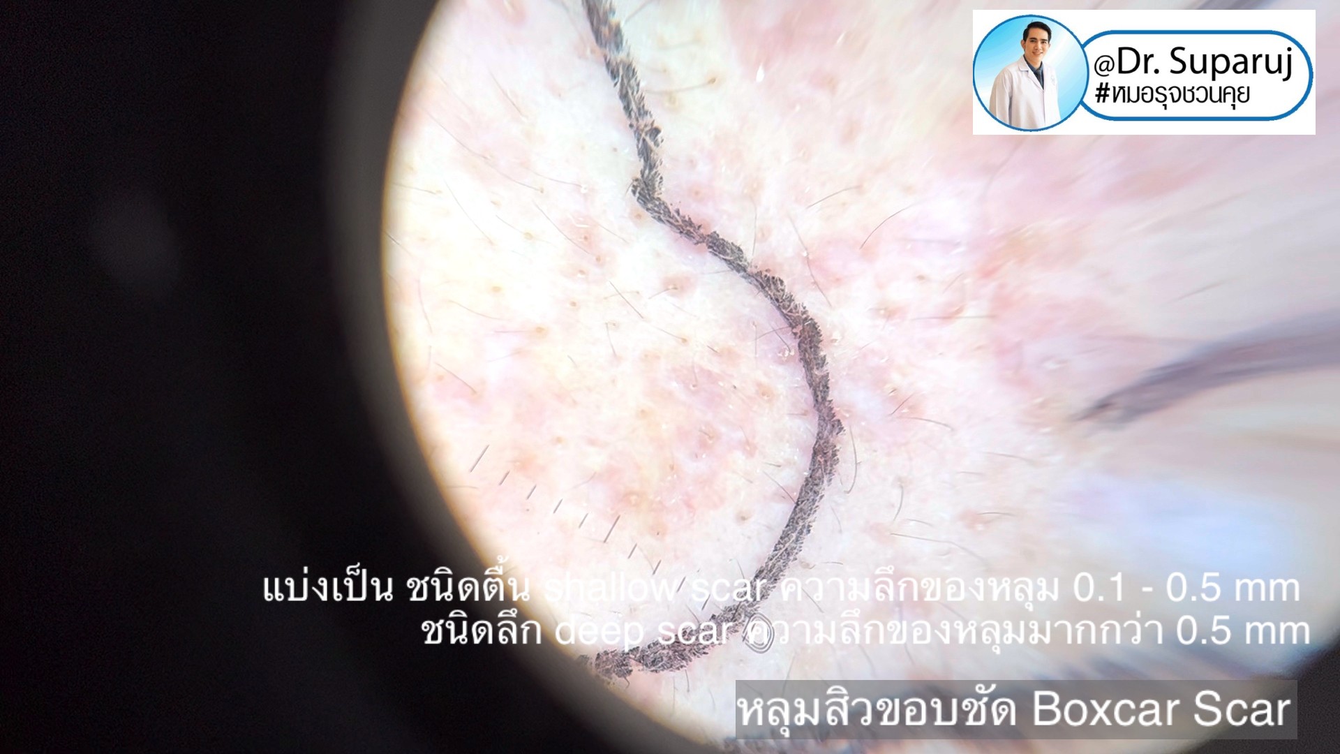 Back to the Basics: หลุมสิวมีกี่ชนิด & มีลักษณะอย่างไร ? Acne Scar Classification Full Clip คลิปเต็ม Facebook/ YouTube Dr. Suparuj หมอรุจชวนคุย ครับ Back to the Basics: หลุมสิวมีกี่ชนิด & มีลักษณะอย่างไร ? Acne Scar Classification Full Clip คลิปเต็ม Facebook/ YouTube Dr. Suparuj หมอรุจชวนคุย ครับ