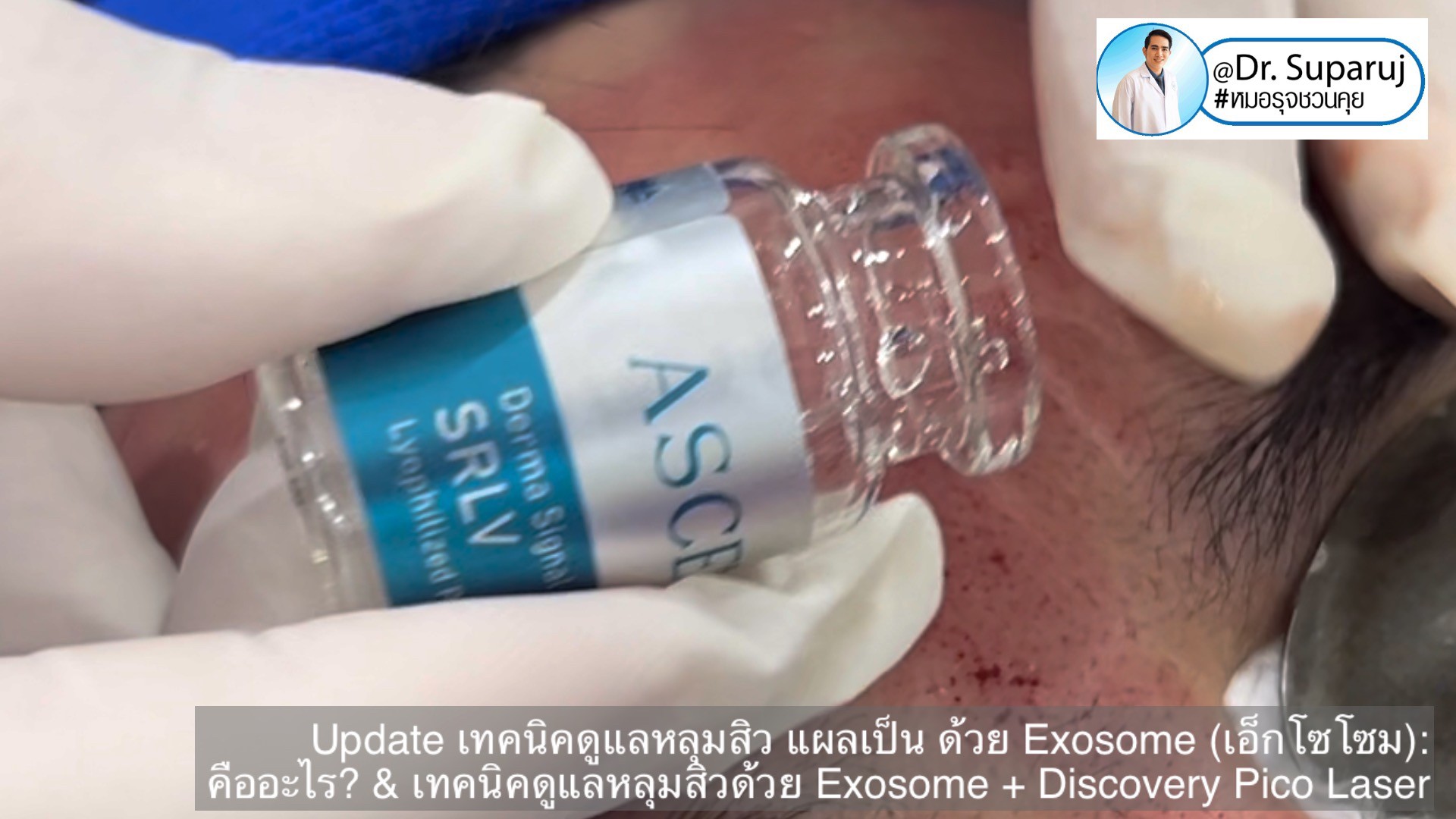 แนะนำเทคนิคในการดูแลหลุมสิว: Exosome ใน การรักษาหลุมสิว (Exosome & acne scar treatment) แนะนำเทคนิคในการดูแลหลุมสิว: Exosome ใน การรักษาหลุมสิว (Exosome & acne scar treatment)