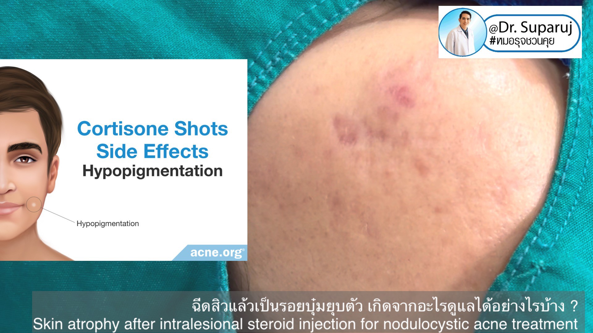 ฉีดสิวแล้วเป็นรอยบุ๋มยุบตัว เกิดจากอะไรดูแลได้อย่างไรบ้าง ?  (Skin atrophy after intralesional steroid injection for nodulocystic acne treatment )