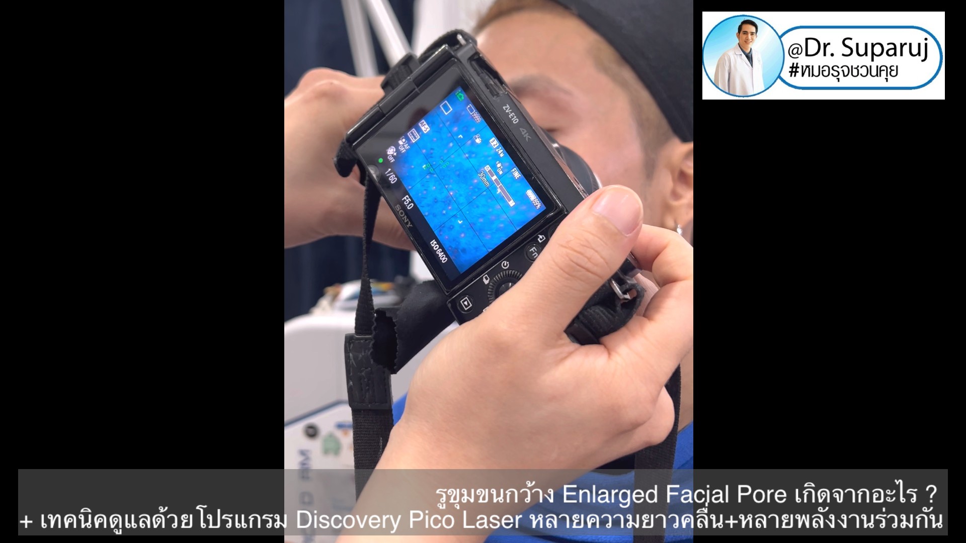 รูขุมขนกว้าง Enlarged Facial Pore เกิดจากอะไร ? + เทคนิคดูแลด้วยโปรแกรม Discovery Pico Laser หลายความยาวคลื่น +หลายพลังงานร่วมกัน รูขุมขนกว้าง Enlarged Facial Pore เกิดจากอะไร ? + เทคนิคดูแลด้วยโปรแกรม Discovery Pico Laser หลายความยาวคลื่น +หลายพลังงานร่วมกัน