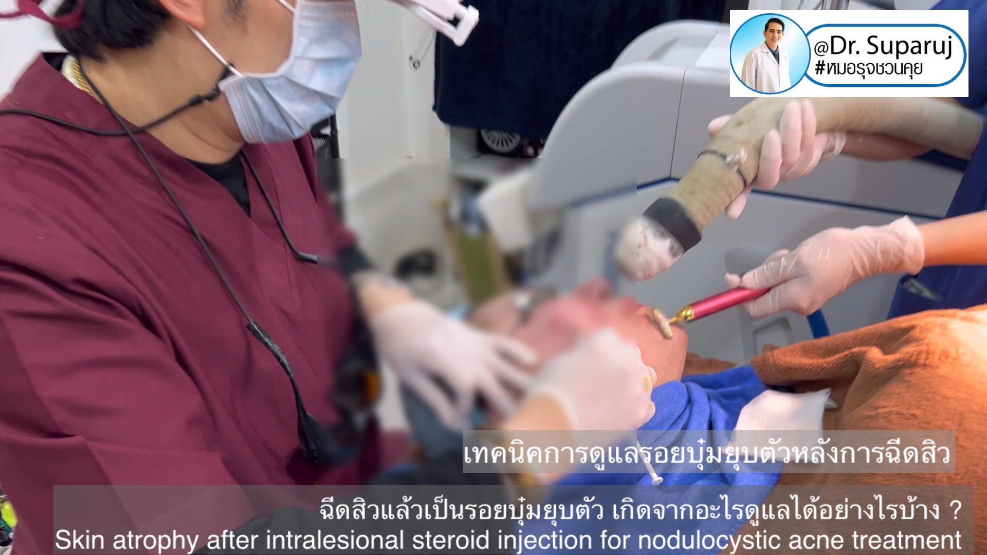 ฉีดสิวแล้วเป็นรอยบุ๋มยุบตัว เกิดจากอะไรดูแลได้อย่างไรบ้าง ? (Skin atrophy after intralesional steroid injection for nodulocystic acne treatment ) ฉีดสิวแล้วเป็นรอยบุ๋มยุบตัว เกิดจากอะไรดูแลได้อย่างไรบ้าง ? (Skin atrophy after intralesional steroid injection for nodulocystic acne treatment )