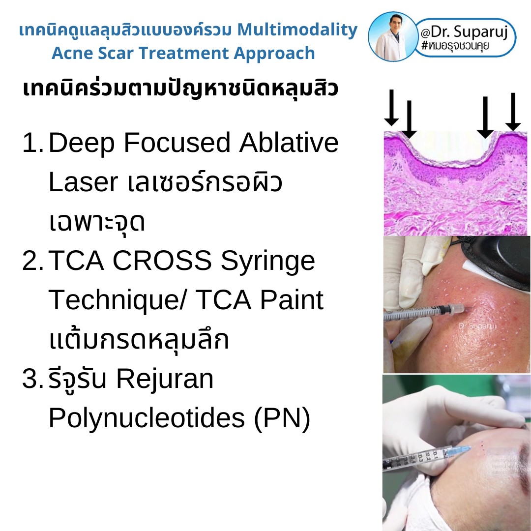 มีปัญหาหลุมสิว แต่ยังมีสิวขึ้นอยู่ สามารถรักษาหลุมสิวได้เลยไหม หรือควรดูแลอย่างไร? มีปัญหาหลุมสิว แต่ยังมีสิวขึ้นอยู่ สามารถรักษาหลุมสิวได้เลยไหม หรือควรดูแลอย่างไร?