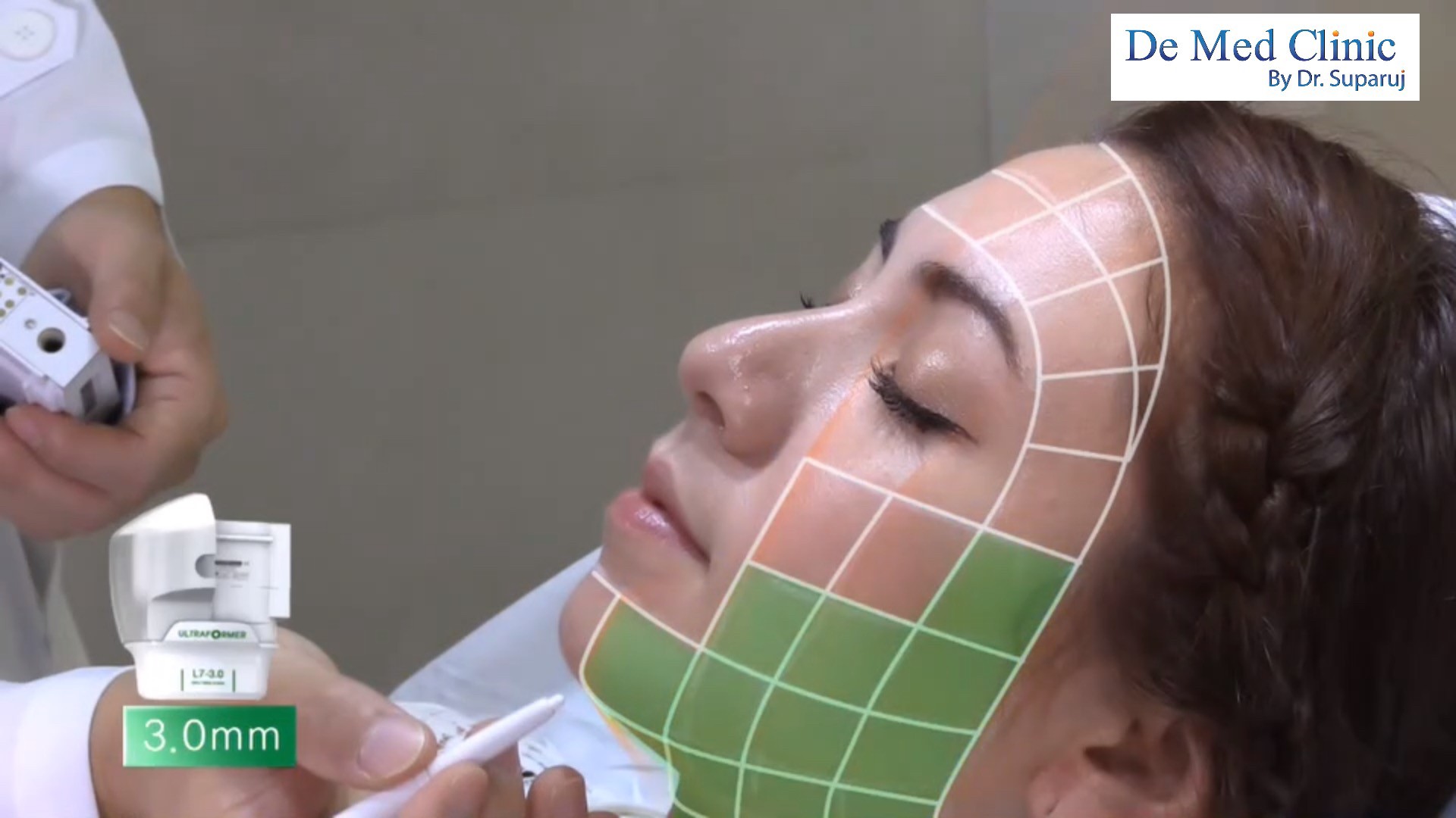 แนะนำเทคนิคดูแล ยกกระชับผิว: Ultraformer III นวัตกรรมคลื่นเสียงยกกระชับ ลดริ้วรอย กระชับผิว ดูแลหลุมสิวโดยไม่ต้องผ่าตัด แนะนำเทคนิคดูแล ยกกระชับผิว: Ultraformer III นวัตกรรมคลื่นเสียงยกกระชับ ลดริ้วรอย กระชับผิว ดูแลหลุมสิวโดยไม่ต้องผ่าตัด