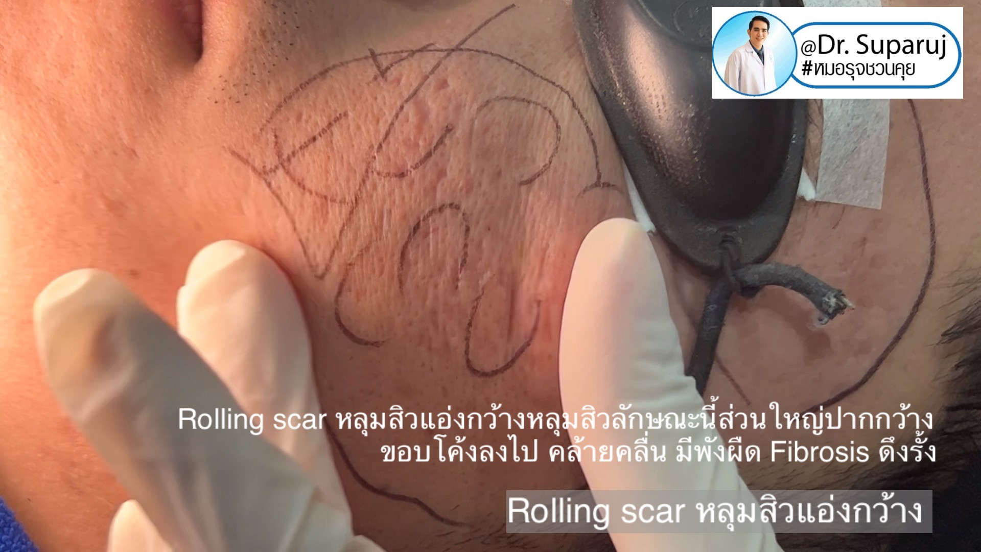 Back to the Basics: หลุมสิวมีกี่ชนิด & มีลักษณะอย่างไร ? Acne Scar Classification Full Clip คลิปเต็ม Facebook/ YouTube Dr. Suparuj หมอรุจชวนคุย ครับ