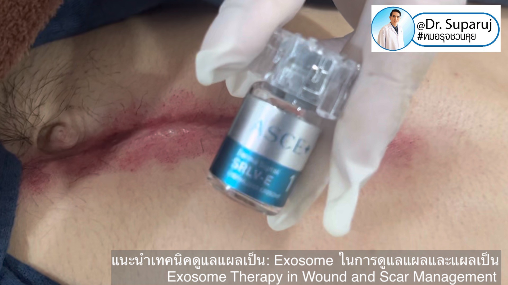 แนะนำเทคนิคดูแลแผลเป็น: Exosome ในการดูแลแผลและแผลเป็น Exosome Therapy in Wound and Scar Management แนะนำเทคนิคดูแลแผลเป็น: Exosome ในการดูแลแผลและแผลเป็น Exosome Therapy in Wound and Scar Management