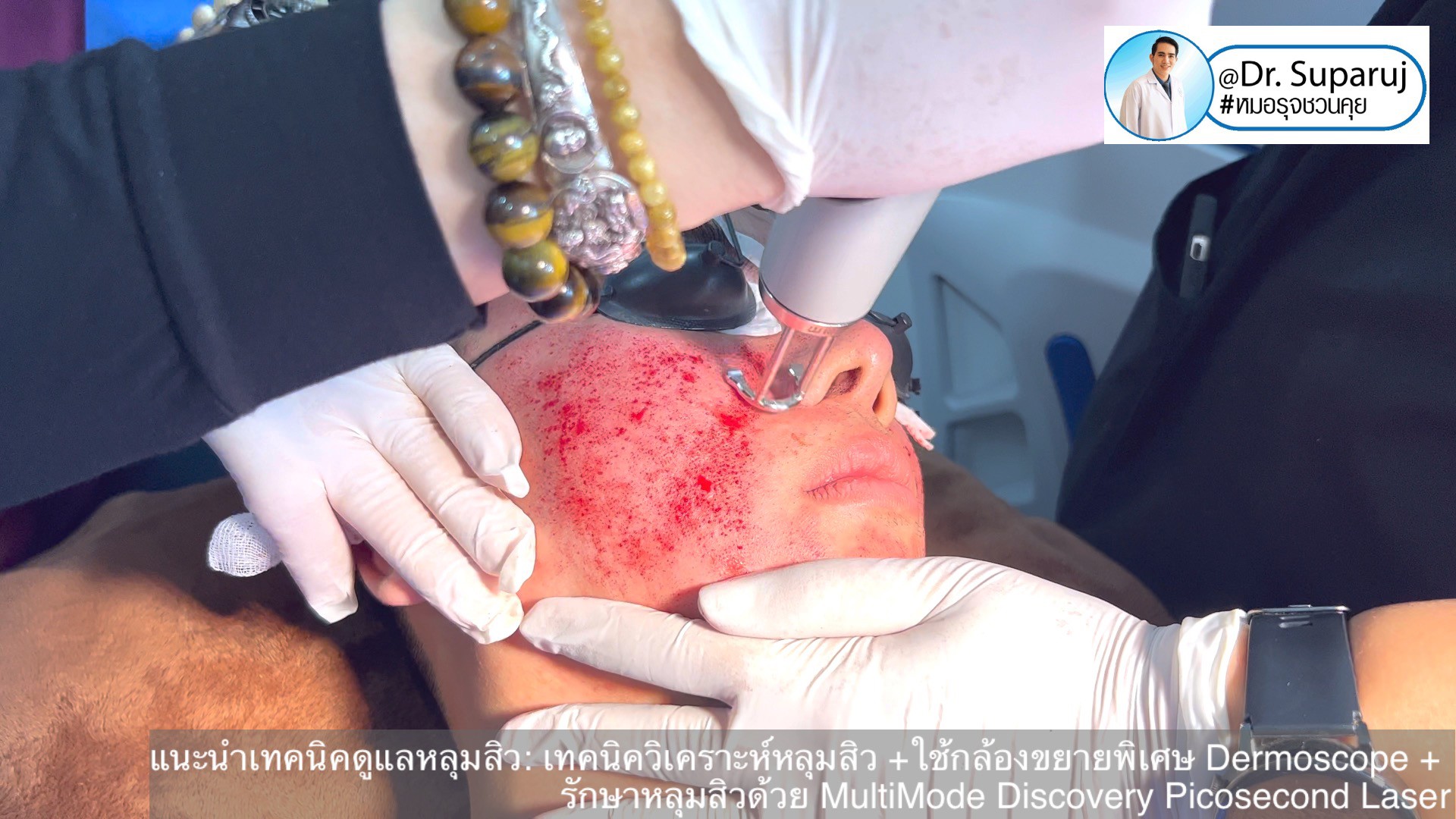 แนะนำเทคนิคดูแลหลุมสิว: เทคนิควิเคราะห์หลุมสิว +ใช้กล้องขยายพิเศษ Dermoscope + รักษาหลุมสิวด้วย MultiMode Discovery Picosecond Laser + Exosome Therapy