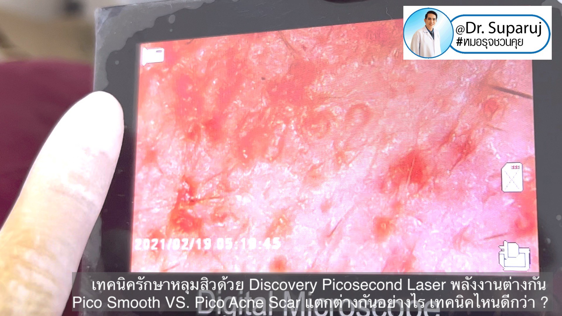 Q:Picosecond Laser หลุมสิวต้องยิงให้เลือดสาดไหม? Q:Picosecond Laser หลุมสิวต้องยิงให้เลือดสาดไหม?