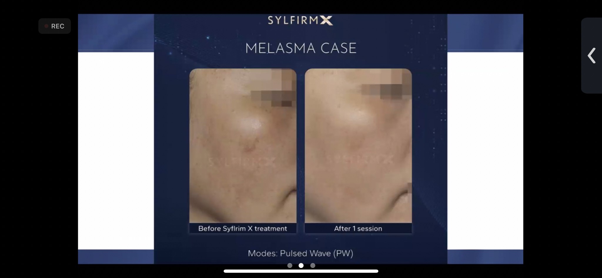 แนะนำเทคนิคดูแลฝ้า ด้วย SYLFIRM X Plus (SYLFIRMX Plus Fractional Radiofrequency Microneedle to Treat Melasma) แนะนำเทคนิคดูแลฝ้า ด้วย SYLFIRM X Plus (SYLFIRMX Plus Fractional Radiofrequency Microneedle to Treat Melasma)