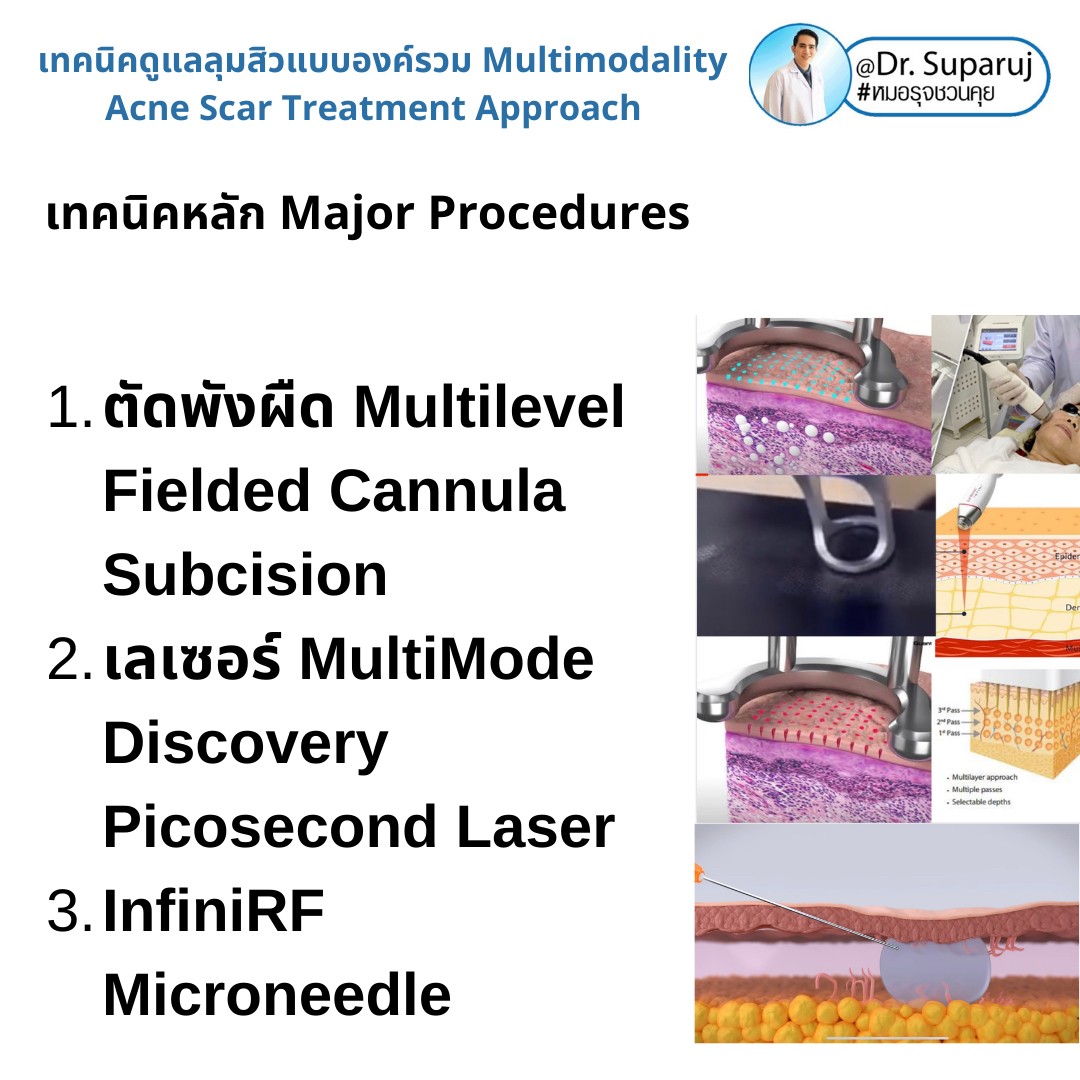 มีปัญหาหลุมสิว แต่ยังมีสิวขึ้นอยู่ สามารถรักษาหลุมสิวได้เลยไหม หรือควรดูแลอย่างไร? มีปัญหาหลุมสิว แต่ยังมีสิวขึ้นอยู่ สามารถรักษาหลุมสิวได้เลยไหม หรือควรดูแลอย่างไร?