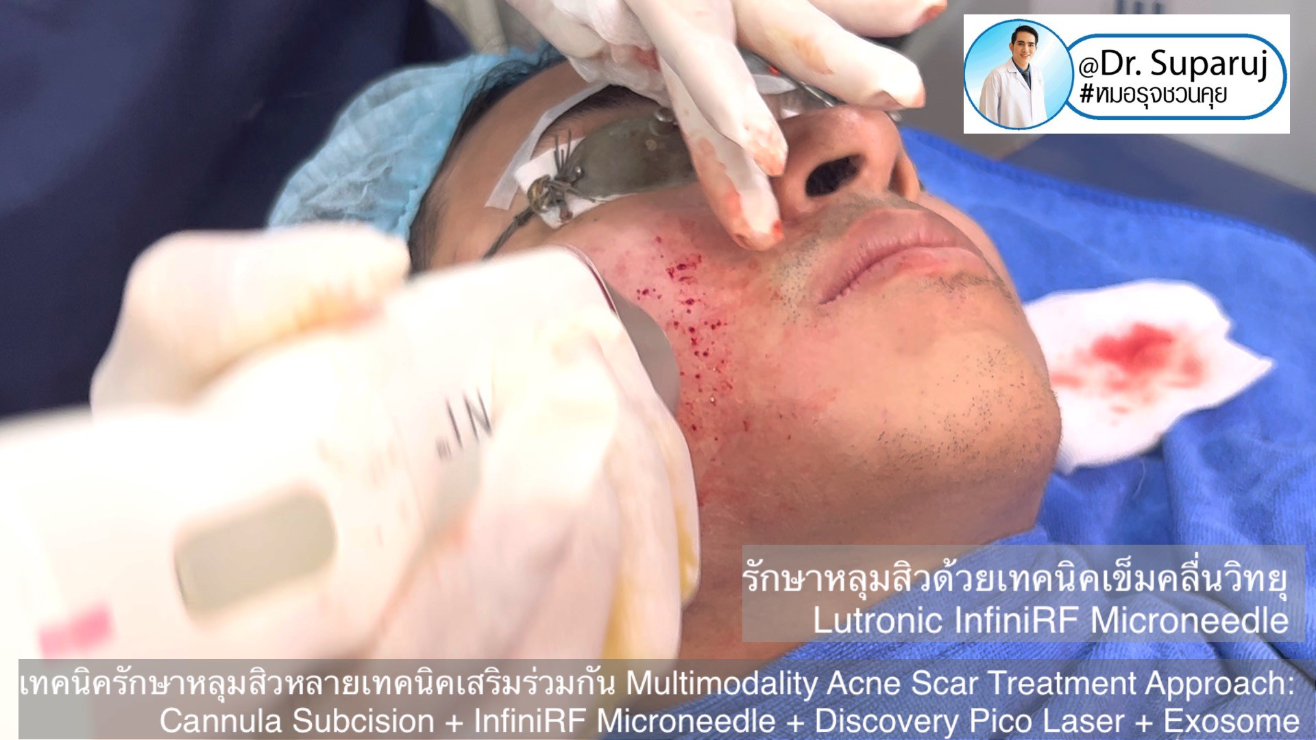 เทคนิครักษาหลุมสิวด้วยหลายเทคนิคเสริมร่วมกัน Multimodality Acne Scar Treatment Approach: Cannula Subcision + InfiniRF Microneedle + Discovery Pico Laser + Exosome เทคนิครักษาหลุมสิวด้วยหลายเทคนิคเสริมร่วมกัน Multimodality Acne Scar Treatment Approach: Cannula Subcision + InfiniRF Microneedle + Discovery Pico Laser + Exosome