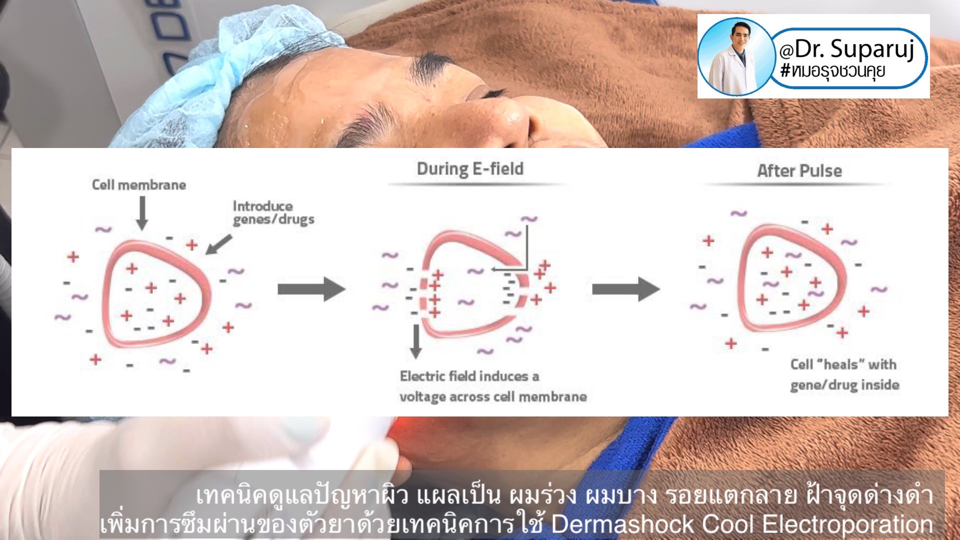 เทคนิคดูแลปัญหาผิว แผลเป็น ผมร่วง ผมบาง รอยแตกลาย ฝ้าจุดด่างดำ เพิ่มการซึมผ่านของตัวยาด้วยเทคนิคการใช้ Dermashock Cool Electroporation เทคนิคดูแลปัญหาผิว แผลเป็น ผมร่วง ผมบาง รอยแตกลาย ฝ้าจุดด่างดำ เพิ่มการซึมผ่านของตัวยาด้วยเทคนิคการใช้ Dermashock Cool Electroporation