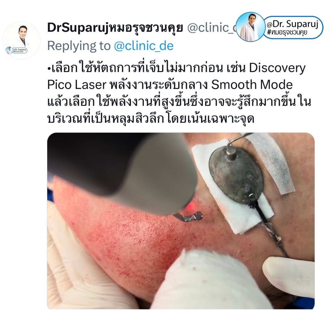 เป็นคนเจ็บง่าย (มากๆ) แต่อยากรักษาหลุมสิว มีเทคนิคอย่างไร? : เทคนิคลดอาการเจ็บจากการรักษาหลุมสิว เป็นคนเจ็บง่าย (มากๆ) แต่อยากรักษาหลุมสิว มีเทคนิคอย่างไร? : เทคนิคลดอาการเจ็บจากการรักษาหลุมสิว