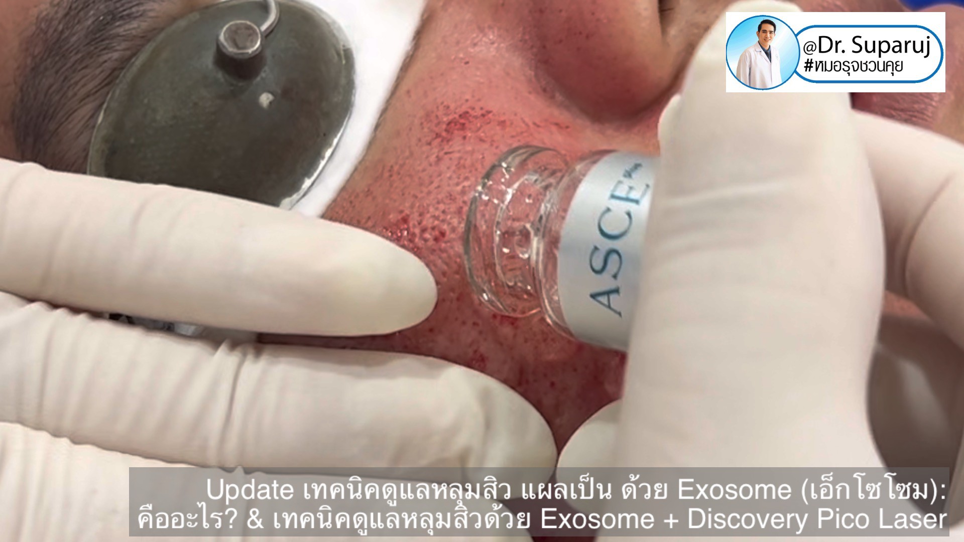 แนะนำเทคนิคในการดูแลหลุมสิว: Exosome ใน การรักษาหลุมสิว (Exosome & acne scar treatment)