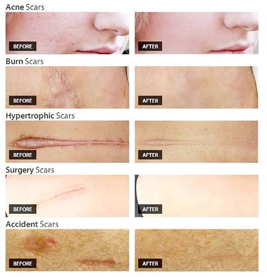 Recap เทคนิครักษาแผลเป็น แผลเป็นนูน คีลอยด์ แผลผ่าตัด Scar Treatment Recap เทคนิครักษาแผลเป็น แผลเป็นนูน คีลอยด์ แผลผ่าตัด Scar Treatment