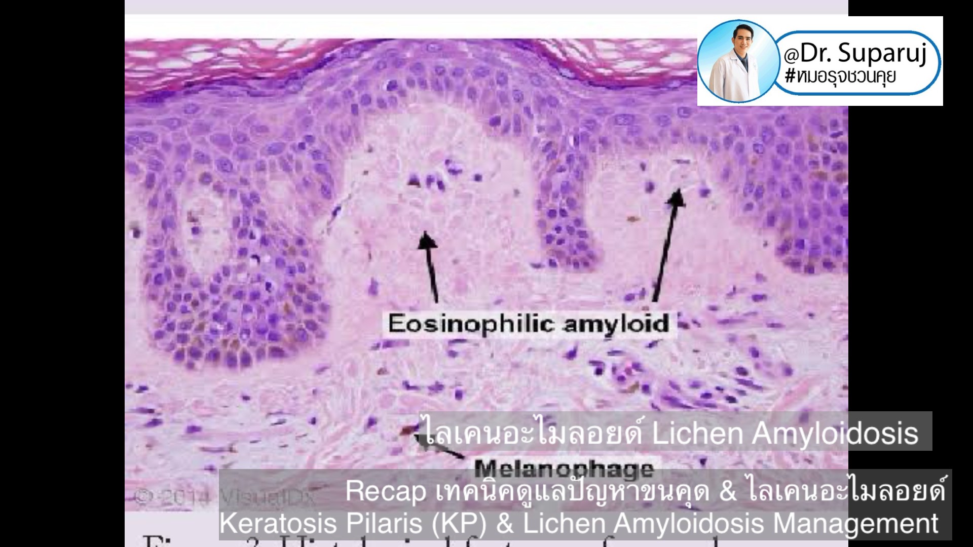 Recap เทคนิคดูแลปัญหาขนคุด & ไลเคนอะไมลอยด์ Keratosis Pilaris (KP) & Lichen Amyloidosis Management