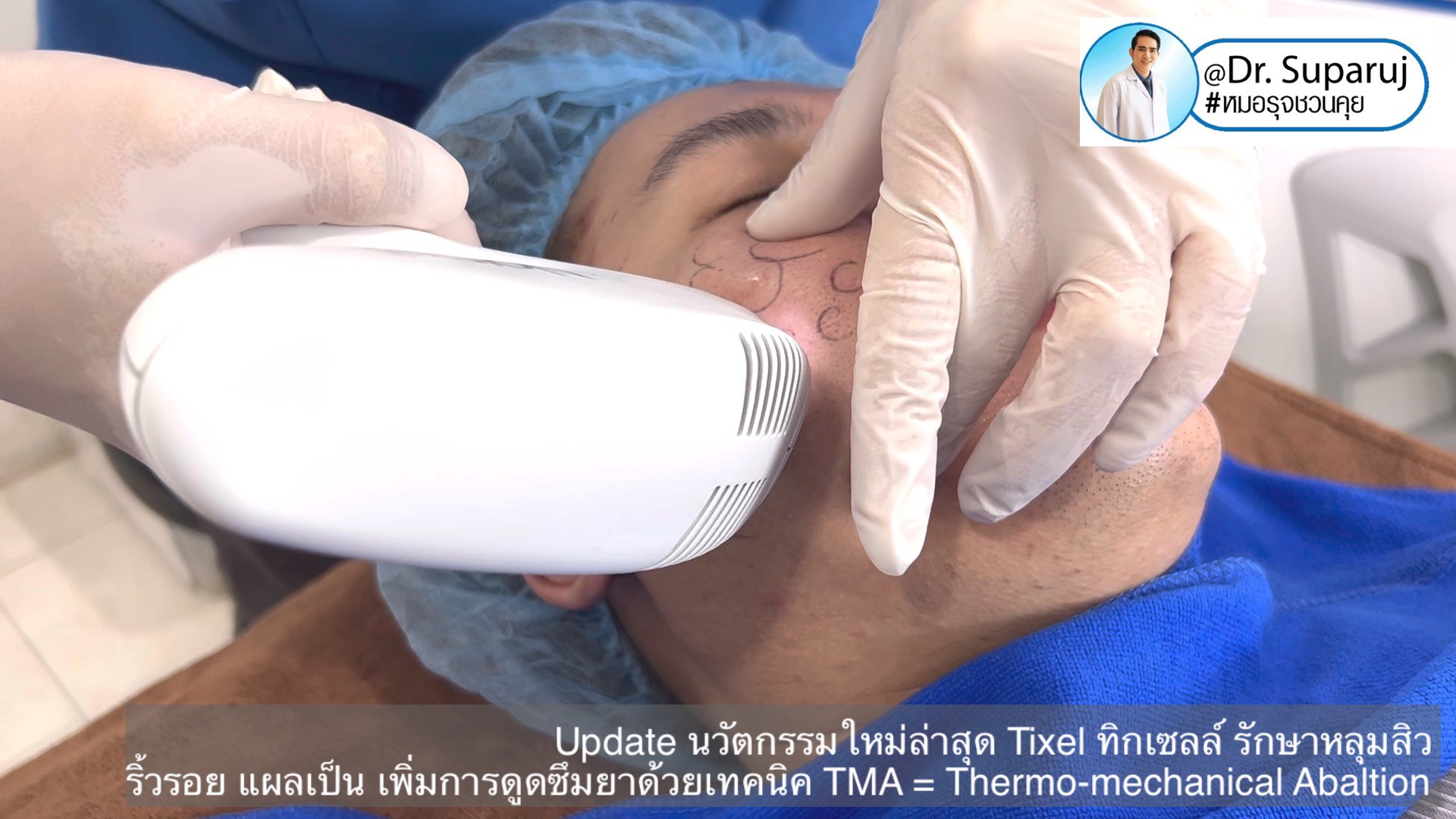 Update นวัตกรรมใหม่ล่าสุด Tixel ทิ๊กเซลล์ รักษาหลุมสิว ริ้วรอย แผลเป็น + Periorbital Tixel Treatment ดูแลริ้วรอยเปลือกตาและรอบดวงตาด้วยเทคนิค TMA = Thermo-mechanical Abaltion