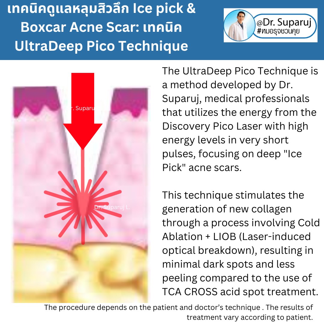 แนะนำเทคนิครักษาหลุมสิวจิกลึก Ice Pick Acne Scar ด้วยเทคนิคเลเซอร์ UltraDeep Pico Technique (Ice Pick Acne Scar Treatment with Discovery Pico Laser + UltraDeep Pico Technique) แนะนำเทคนิครักษาหลุมสิวจิกลึก Ice Pick Acne Scar ด้วยเทคนิคเลเซอร์ UltraDeep Pico Technique (Ice Pick Acne Scar Treatment with Discovery Pico Laser + UltraDeep Pico Technique)