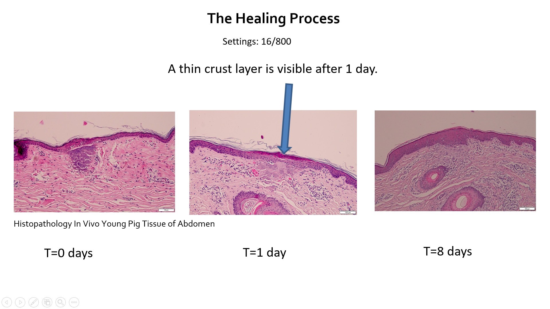 Update เทคนิครักษาหลุมสิว: Tixel ทิ๊กเซลล์ รักษาหลุมสิว ริ้วรอย แผลเป็น เพิ่มการดูดซึมยาด้วยเทคนิค TMA = Thermo-mechanical Abaltion Update เทคนิครักษาหลุมสิว: Tixel ทิ๊กเซลล์ รักษาหลุมสิว ริ้วรอย แผลเป็น เพิ่มการดูดซึมยาด้วยเทคนิค TMA = Thermo-mechanical Abaltion
