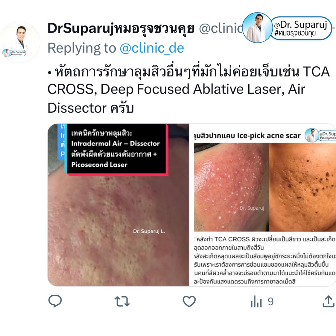 เป็นคนเจ็บง่าย (มากๆ) แต่อยากรักษาหลุมสิว มีเทคนิคอย่างไร? : เทคนิคลดอาการเจ็บจากการรักษาหลุมสิว เป็นคนเจ็บง่าย (มากๆ) แต่อยากรักษาหลุมสิว มีเทคนิคอย่างไร? : เทคนิคลดอาการเจ็บจากการรักษาหลุมสิว