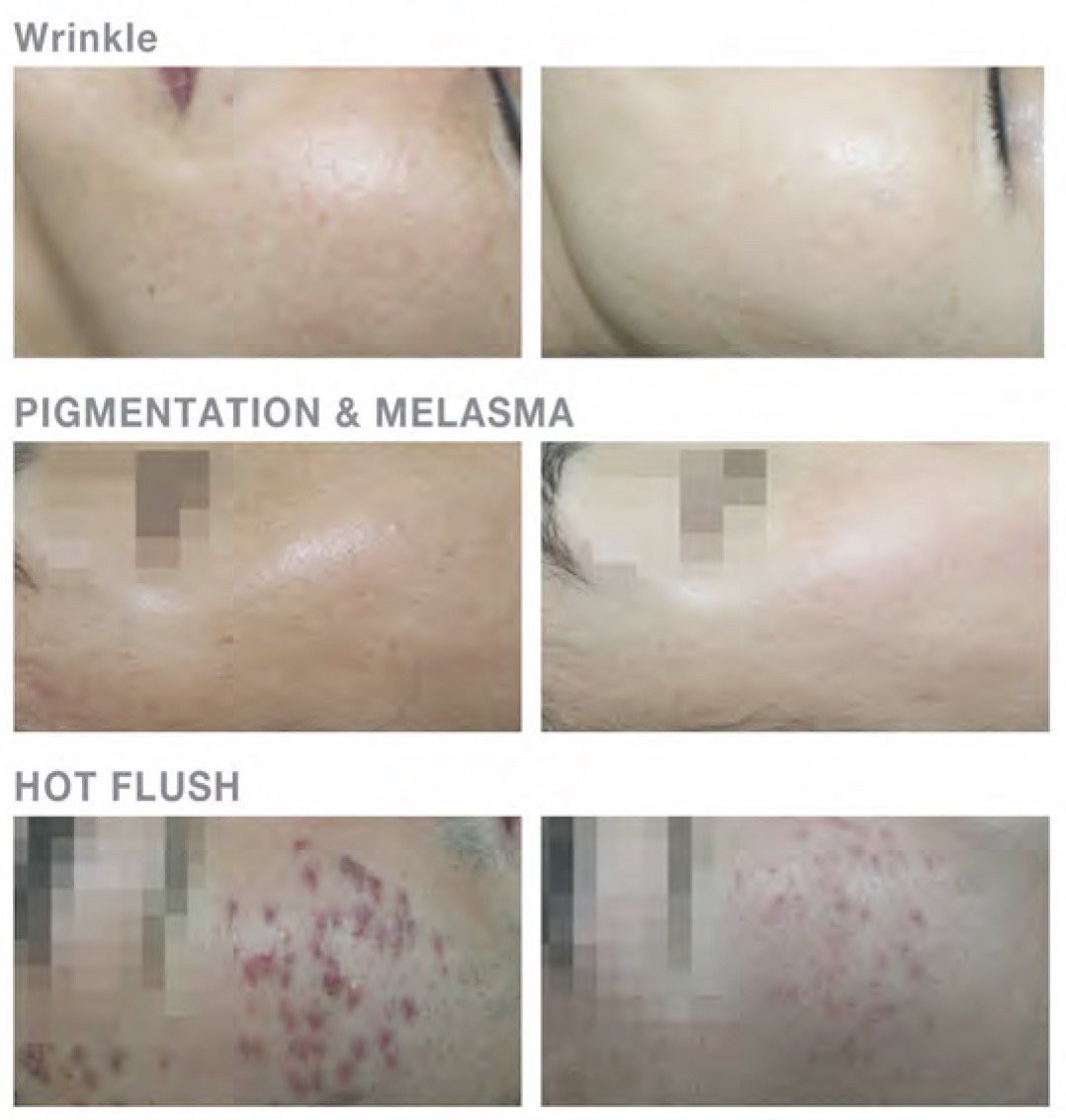 แนะนำเทคนิคดูแลหลุมสิว: Air Dissector ตัดพังผืดด้วยแรงดันอากาศ มีเทคนิคอย่างไร ช่วยดูแลหลุมสิวชนิดไหนได้ ใช้แทนการตัดพังผืด Subcision ได้ไหม ? แนะนำเทคนิคดูแลหลุมสิว: Air Dissector ตัดพังผืดด้วยแรงดันอากาศ มีเทคนิคอย่างไร ช่วยดูแลหลุมสิวชนิดไหนได้ ใช้แทนการตัดพังผืด Subcision ได้ไหม ?