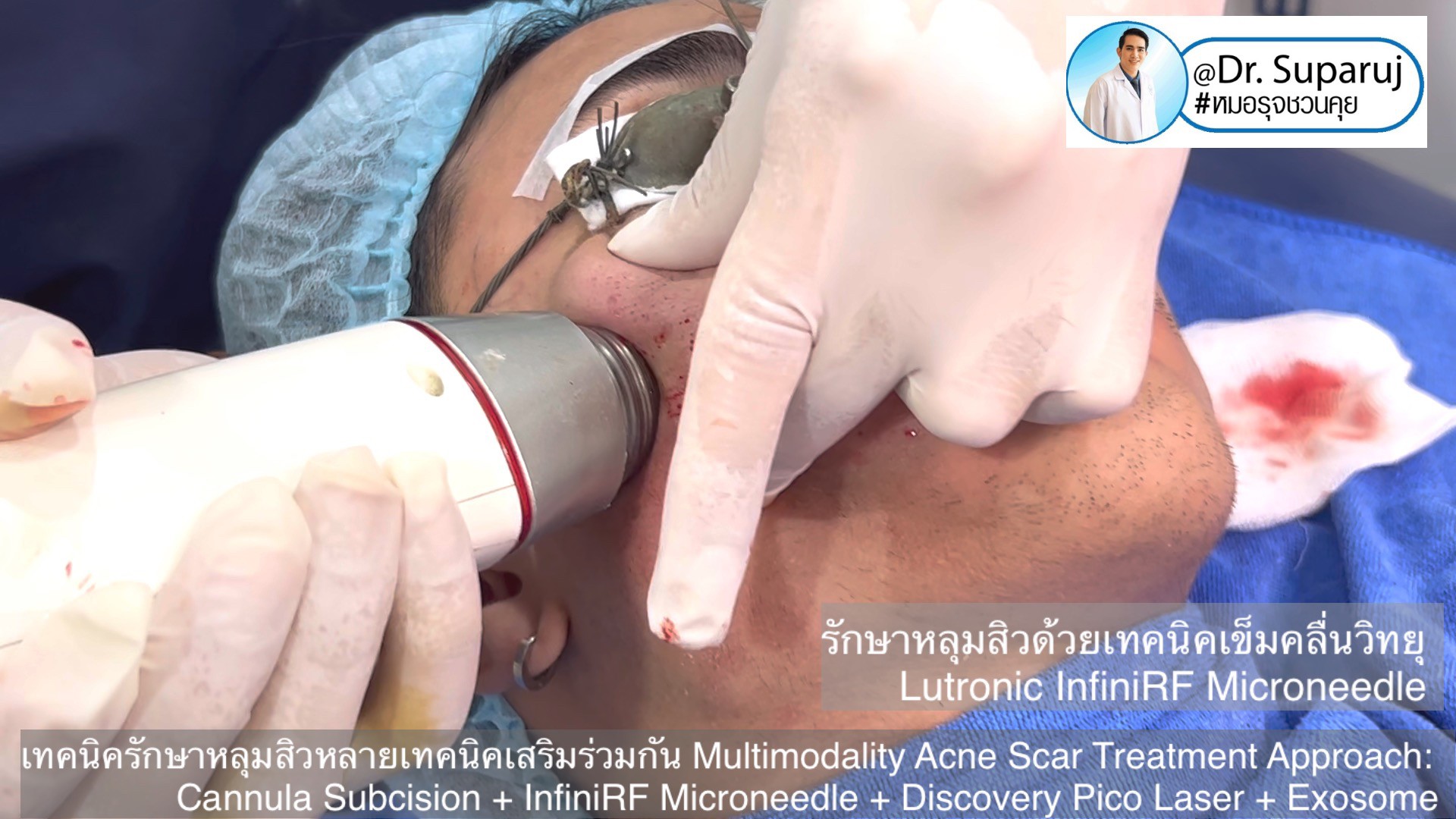 เทคนิครักษาหลุมสิวด้วยหลายเทคนิคเสริมร่วมกัน Multimodality Acne Scar Treatment Approach: Cannula Subcision + InfiniRF Microneedle + Discovery Pico Laser + Exosome เทคนิครักษาหลุมสิวด้วยหลายเทคนิคเสริมร่วมกัน Multimodality Acne Scar Treatment Approach: Cannula Subcision + InfiniRF Microneedle + Discovery Pico Laser + Exosome