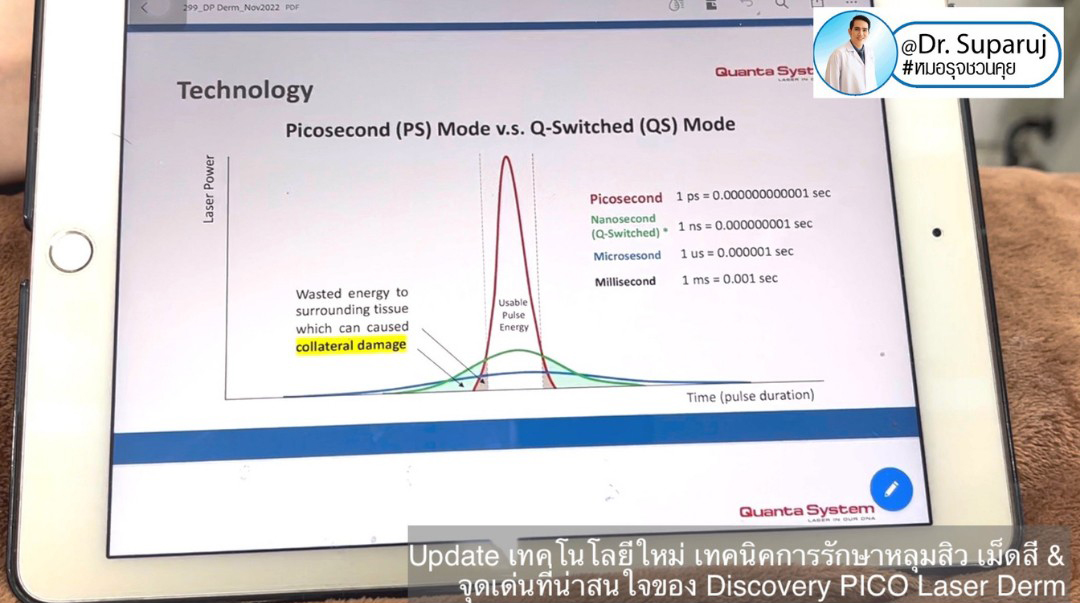 Update Discovery Picosecond Laser จุดเด่น & หลักการทำงาน ใช้ดูแลหลุมสิว แผลเป็น รอยแตกลาย ฝ้า กระจุดด่างดำ ได้อย่างไร ? 