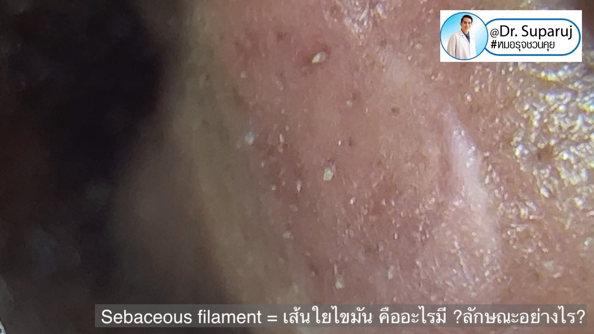 Sebaceous filament = เส้นใยไขมัน คืออะไรมี ?ลักษณะอย่างไร ? ดูแลได้อย่างไร? (คลิปเต็ม Full Clip YouTube Facebook: Dr. Suparuj ครับ