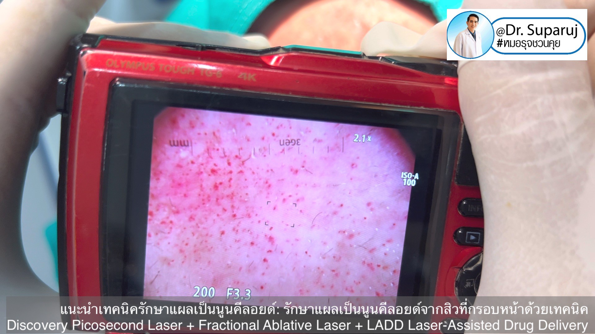 แนะนำเทคนิคดูแลแผลเป็นนูนคีลอยด์: รักษาแผลเป็นนูนคีลอยด์จากสิวที่กรอบหน้าด้วยเทคนิค Discovery Picosecond Laser + Fractional Ablative Laser + LADD Laser-Assisted Drug Delivery แนะนำเทคนิคดูแลแผลเป็นนูนคีลอยด์: รักษาแผลเป็นนูนคีลอยด์จากสิวที่กรอบหน้าด้วยเทคนิค Discovery Picosecond Laser + Fractional Ablative Laser + LADD Laser-Assisted Drug Delivery