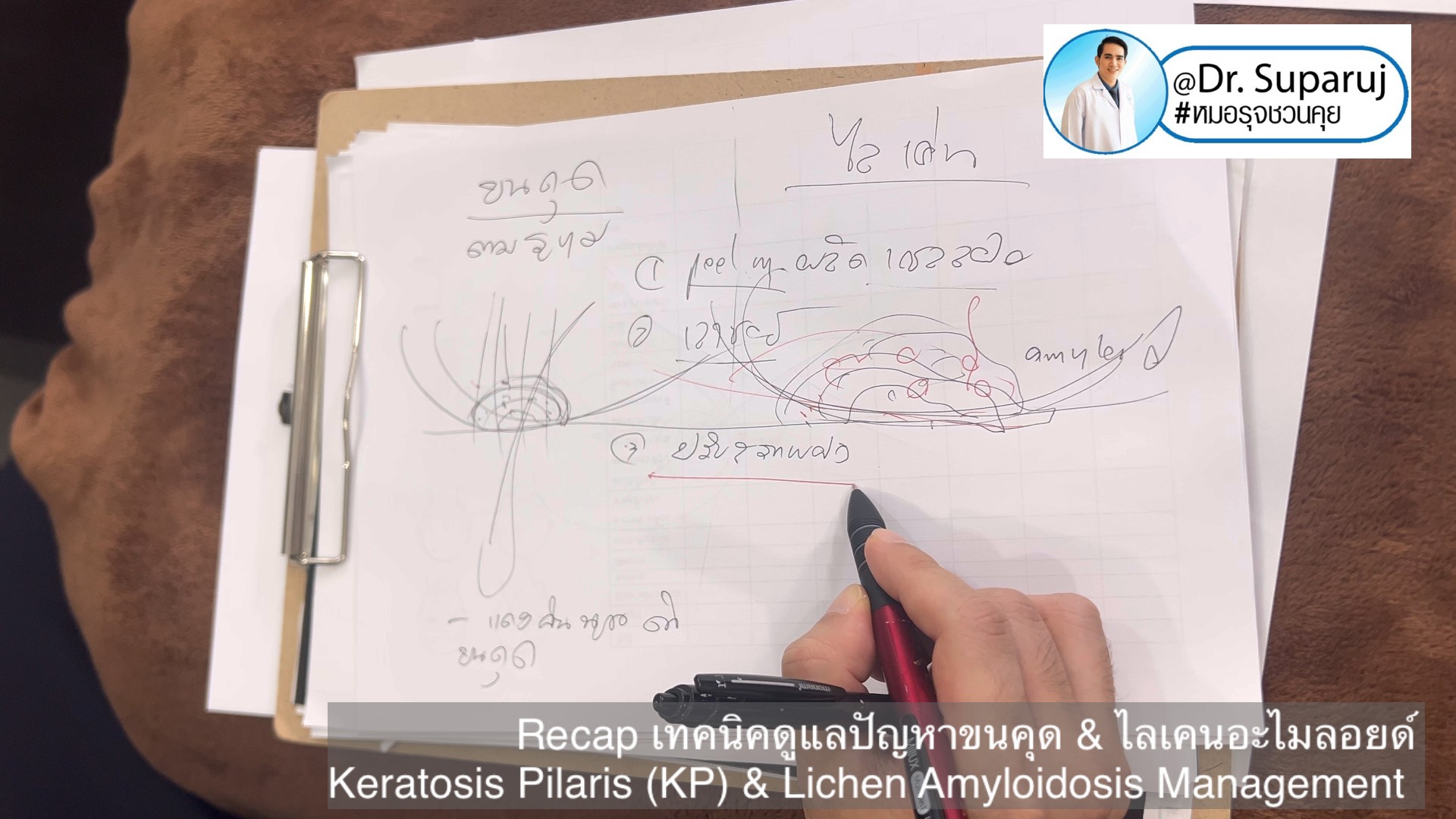 Recap เทคนิคดูแลปัญหาขนคุด & ไลเคนอะไมลอยด์ Keratosis Pilaris (KP) & Lichen Amyloidosis Management