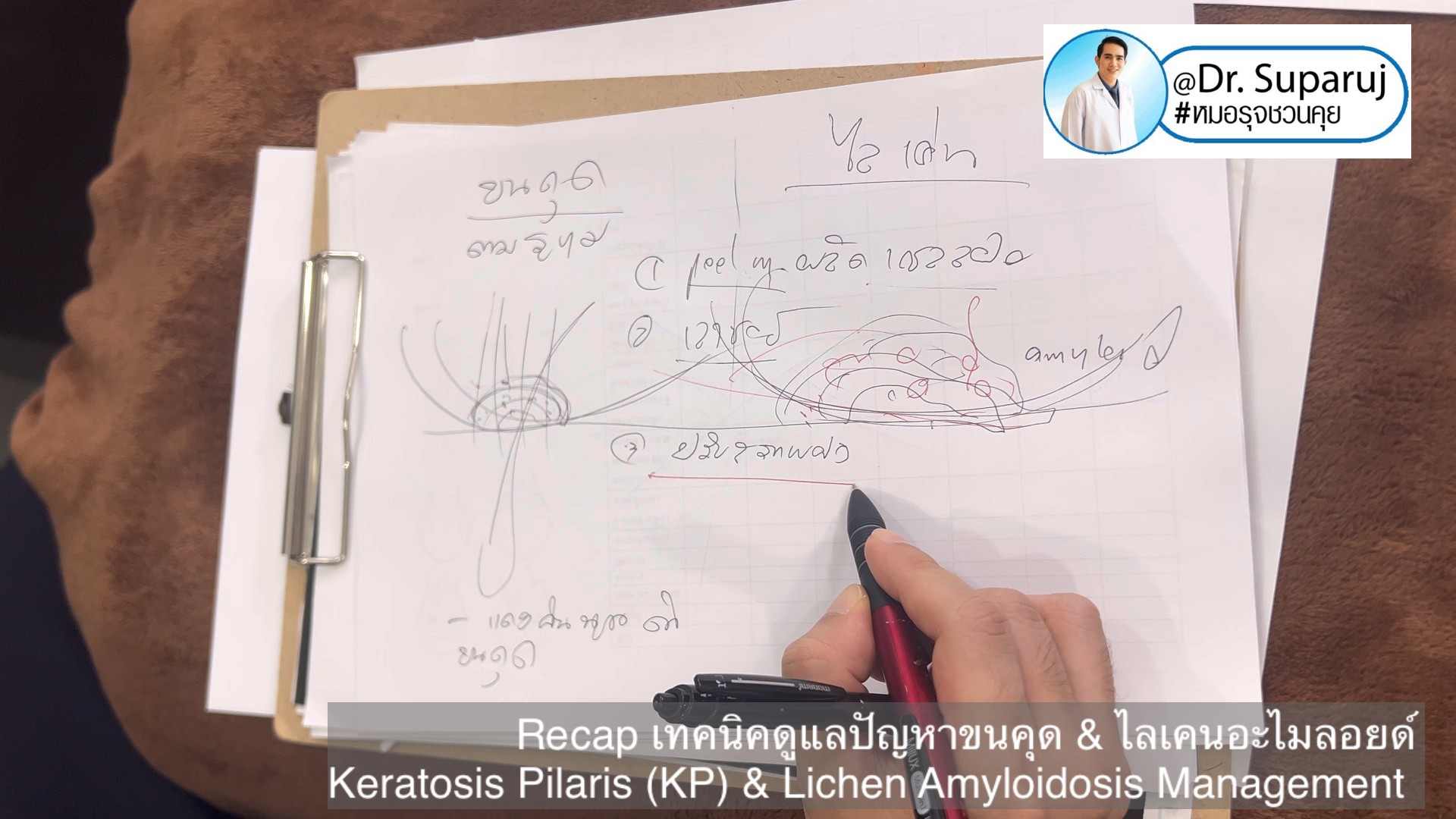 Recap เทคนิคดูแลปัญหาขนคุด & ไลเคนอะไมลอยด์ Keratosis Pilaris (KP) & Lichen Amyloidosis Management Recap เทคนิคดูแลปัญหาขนคุด & ไลเคนอะไมลอยด์ Keratosis Pilaris (KP) & Lichen Amyloidosis Management