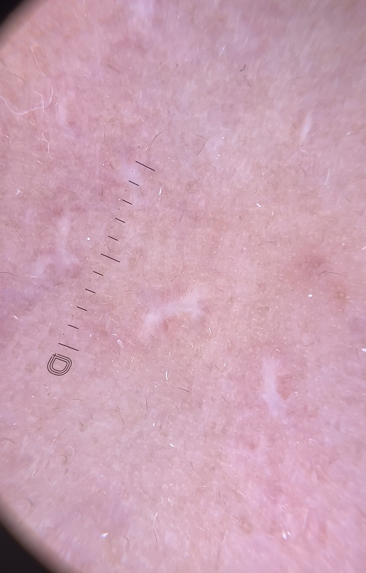 แผลเป็นจากสิวที่มีลักษณะสีขาว severe fibrotic acne scar เกิดจากอะไร & ดูแลได้อย่างไร ?