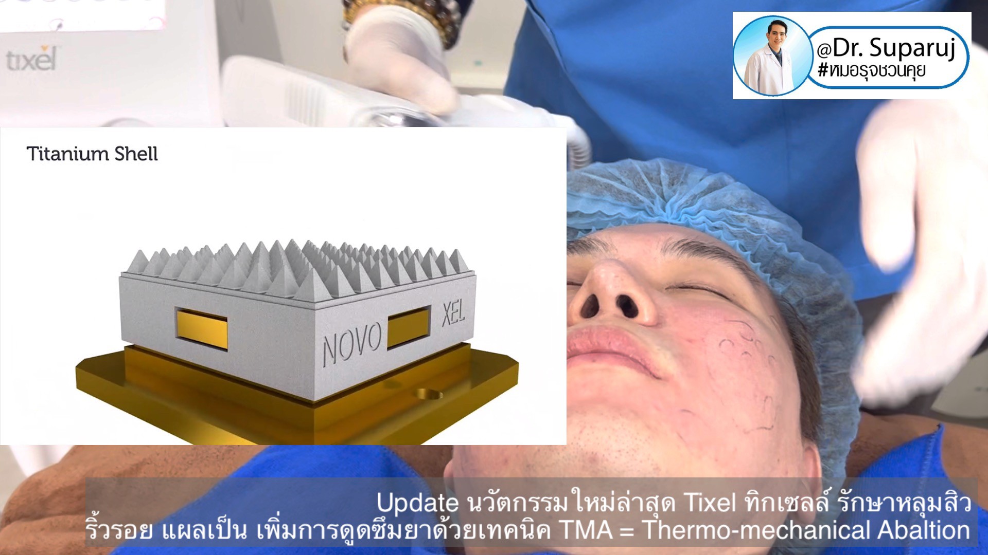 Update นวัตกรรมใหม่ล่าสุด Tixel ทิ๊กเซลล์ รักษาหลุมสิว ริ้วรอย แผลเป็น + Periorbital Tixel Treatment ดูแลริ้วรอยเปลือกตาและรอบดวงตาด้วยเทคนิค TMA = Thermo-mechanical Abaltion