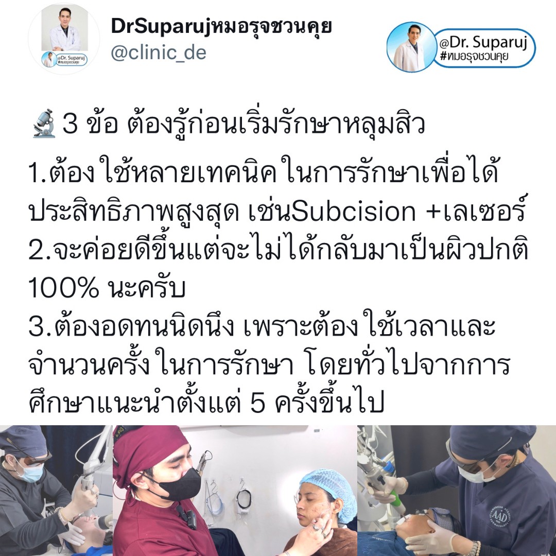 มีปัญหาหลุมสิว แต่ยังมีสิวขึ้นอยู่ สามารถรักษาหลุมสิวได้เลยไหม หรือควรดูแลอย่างไร? มีปัญหาหลุมสิว แต่ยังมีสิวขึ้นอยู่ สามารถรักษาหลุมสิวได้เลยไหม หรือควรดูแลอย่างไร?