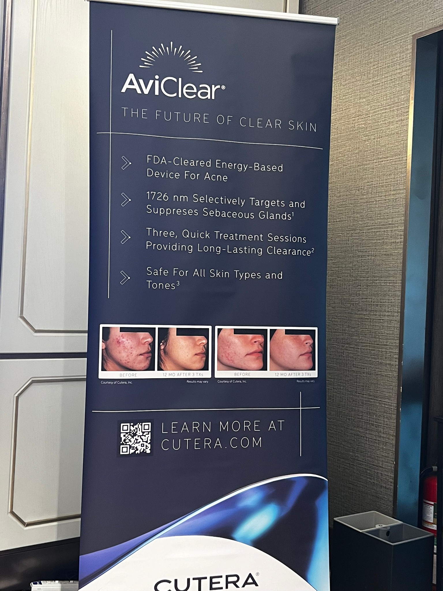 Update เครื่องเลเซอร์สำหรับรักษาสิวโดยเฉพาะ จับกับต่อมไขมันโดยตรง = AviClear 1726 nm Laser