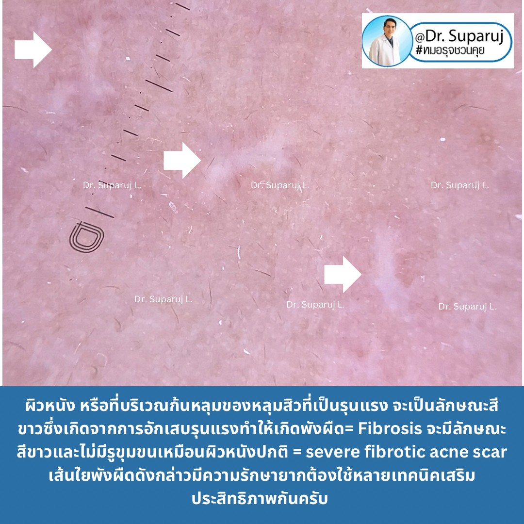 แผลเป็นจากสิวที่มีลักษณะสีขาว severe fibrotic acne scar เกิดจากอะไร & ดูแลได้อย่างไร ? แผลเป็นจากสิวที่มีลักษณะสีขาว severe fibrotic acne scar เกิดจากอะไร & ดูแลได้อย่างไร ?