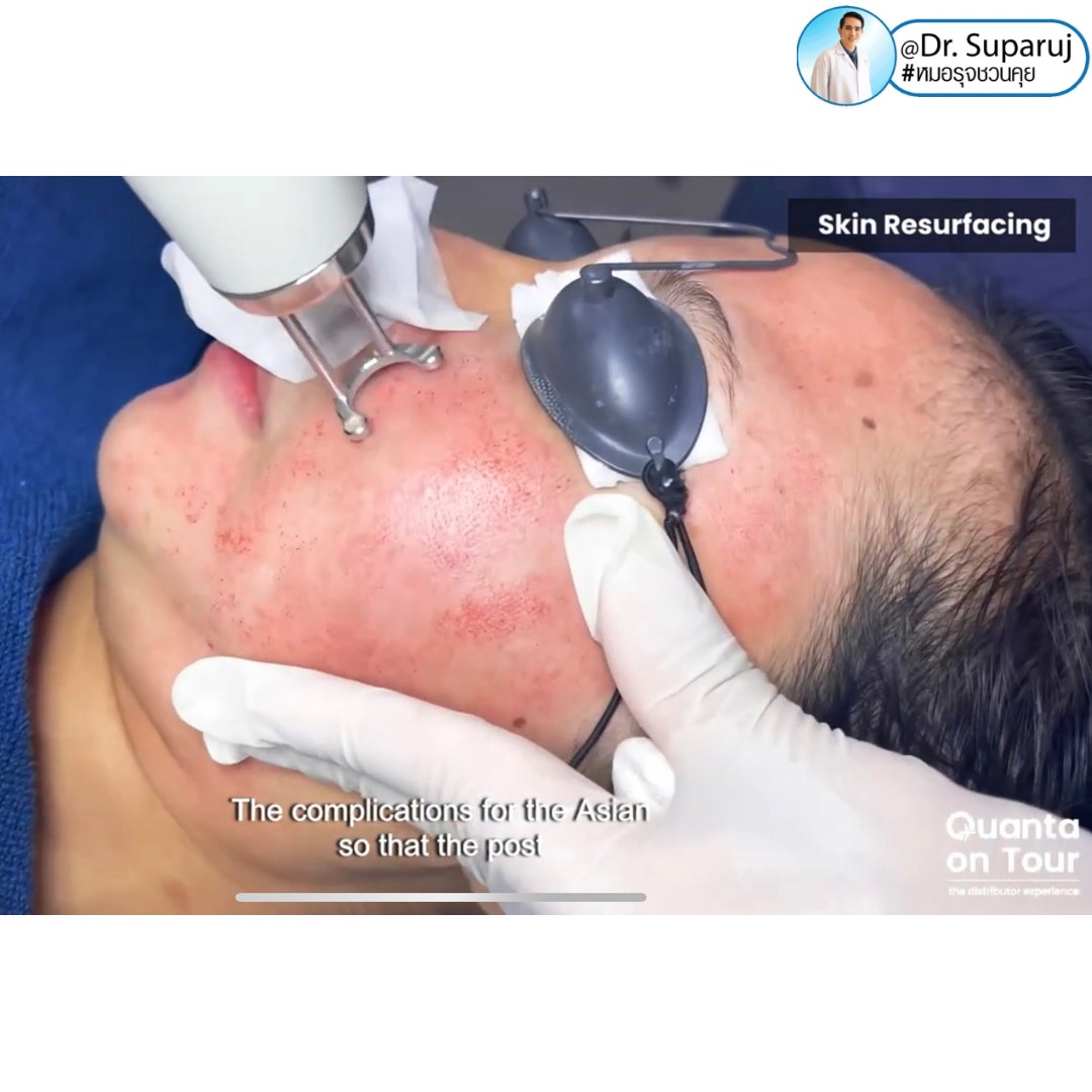 Quanta On Tour - Thailand - Dr. Suparuj DEMED CLINIC about Discovery Pico Laser & Acne Scar Treatment August 2023 - Quanta goes to Thailand to support and highlight the experience of its exclusive distributor for aesthetic lasers Lasermed, by visiting Quanta On Tour - Thailand - Dr. Suparuj DEMED CLINIC about Discovery Pico Laser & Acne Scar Treatment August 2023 - Quanta goes to Thailand to support and highlight the experience of its exclusive distributor for aesthetic lasers Lasermed, by visiting