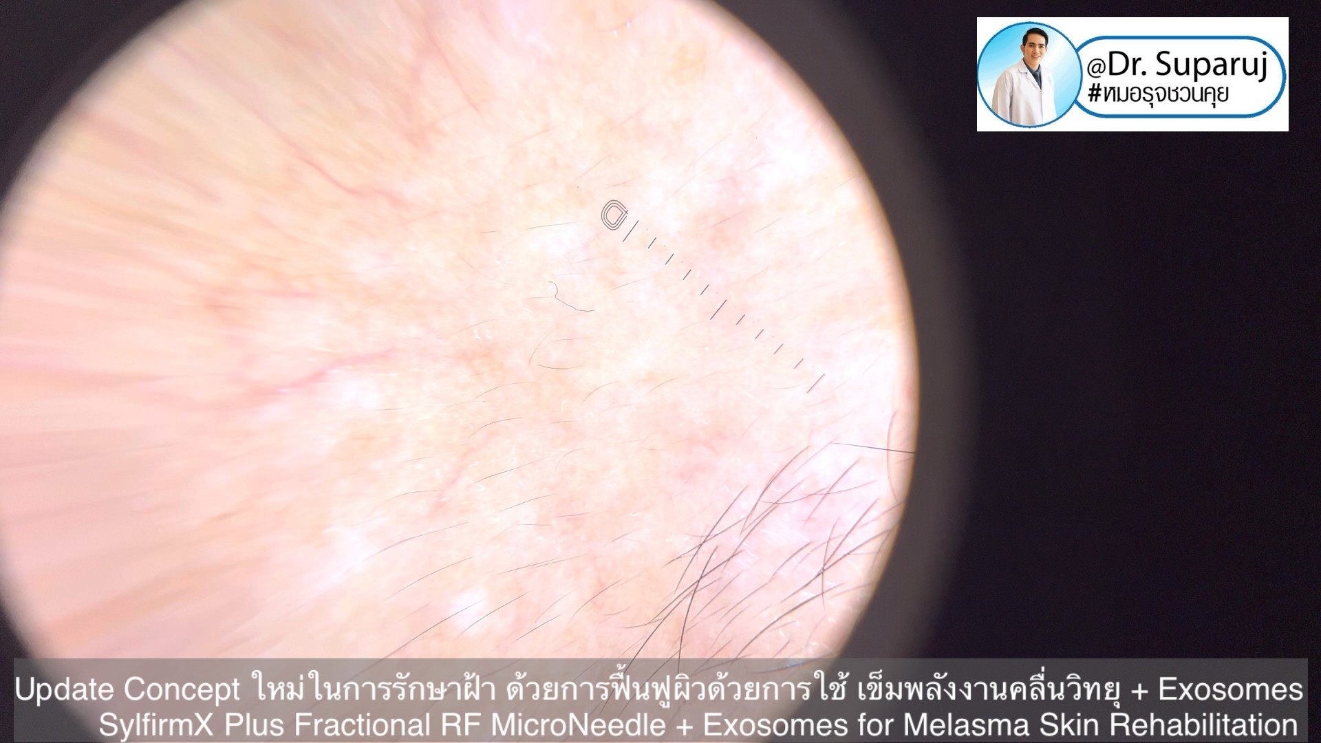 Update Concept ใหม่ในการรักษาฝ้า ด้วยการฟื้นฟูผิวด้วยการใช้ เข็มพลังงานคลื่นวิทยุ + Exosomes (SylfirmX Plus Fractional RF MicroNeedle + Exosomes for Melasma Skin Rehabilitation) Update Concept ใหม่ในการรักษาฝ้า ด้วยการฟื้นฟูผิวด้วยการใช้ เข็มพลังงานคลื่นวิทยุ + Exosomes (SylfirmX Plus Fractional RF MicroNeedle + Exosomes for Melasma Skin Rehabilitation)