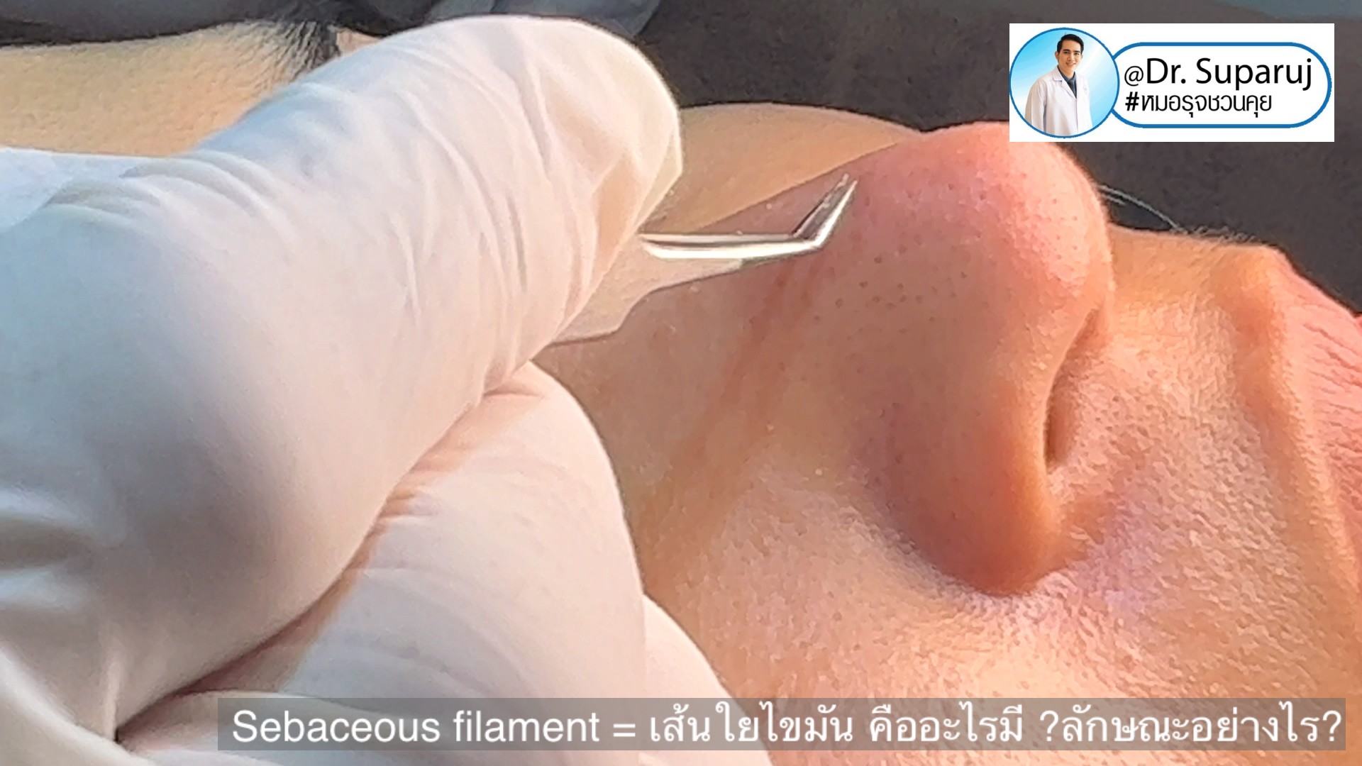 Sebaceous filament = เส้นใยไขมัน คืออะไรมี ?ลักษณะอย่างไร ? ดูแลได้อย่างไร? (คลิปเต็ม Full Clip YouTube Facebook: Dr. Suparuj ครับ Sebaceous filament = เส้นใยไขมัน คืออะไรมี ?ลักษณะอย่างไร ? ดูแลได้อย่างไร? (คลิปเต็ม Full Clip YouTube Facebook: Dr. Suparuj ครับ