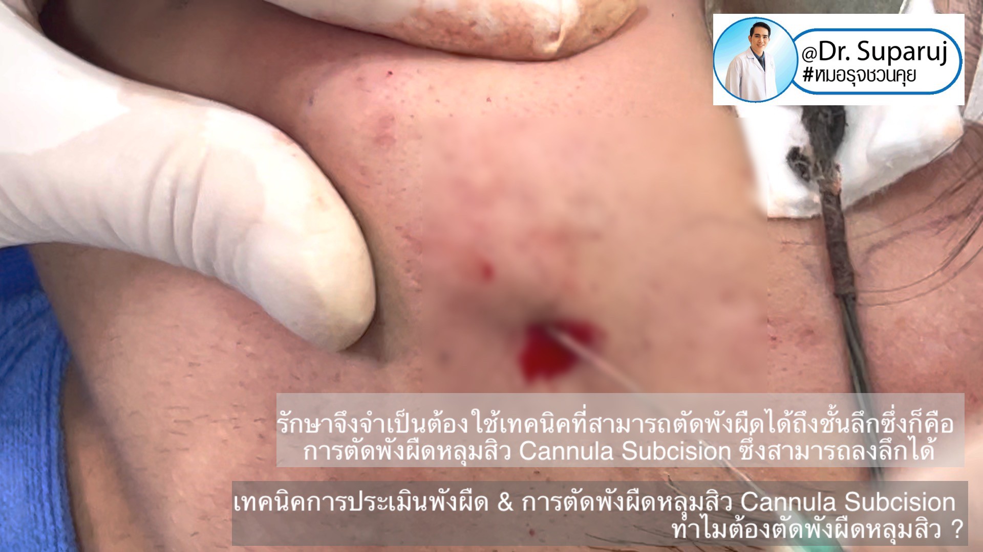 เทคนิคการประเมินพังผืด และการตัดพังผืดหลุมสิว Cannula Subcision ทำไมต้องตัดพังผืดรักษาหลุมสิว ?  (Acne Scar Fibrosis Evaluation & Cannula Subcision Treatment)